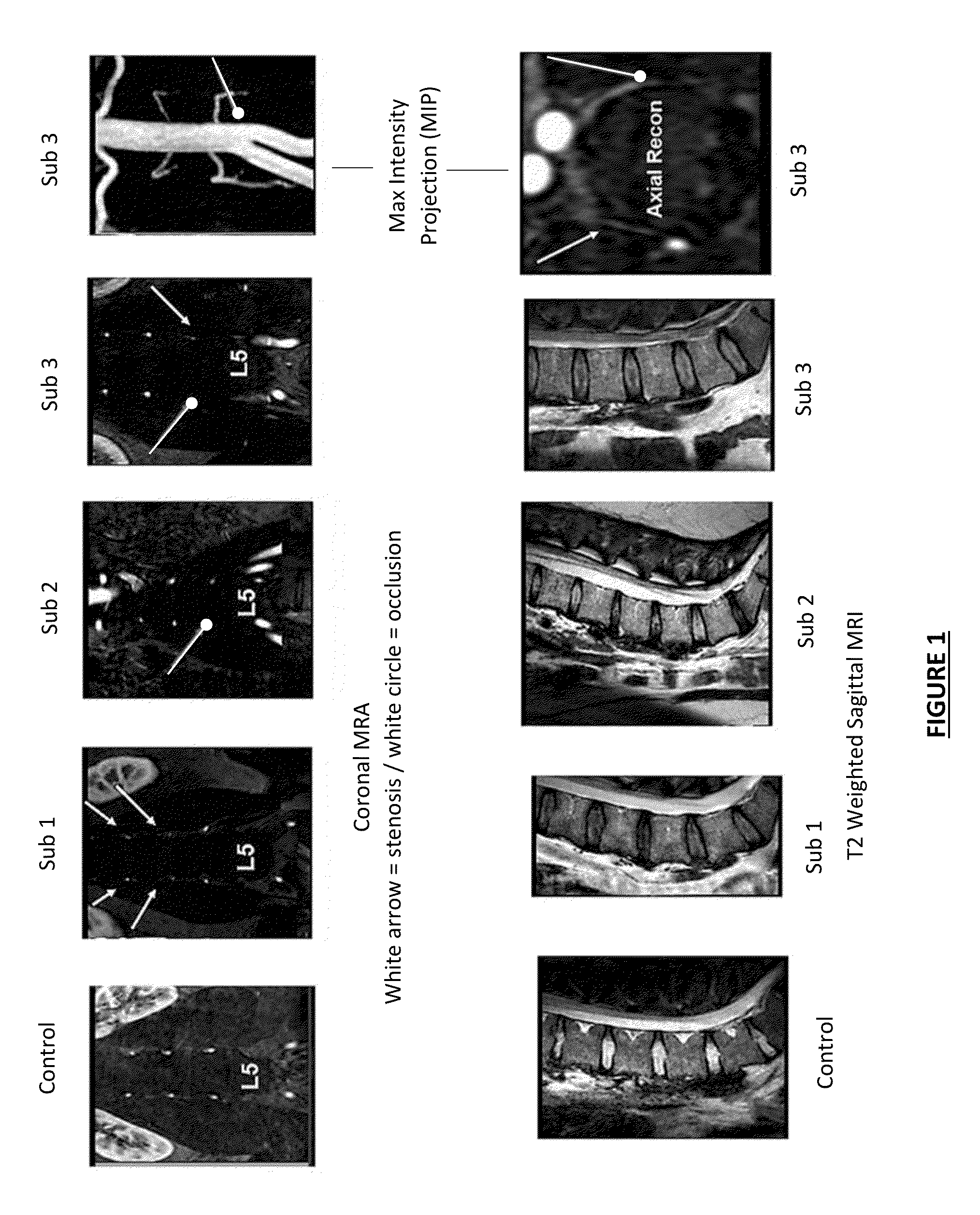 Therapeutic Angiogenesis for Treatment of the Spine and Other Tissues