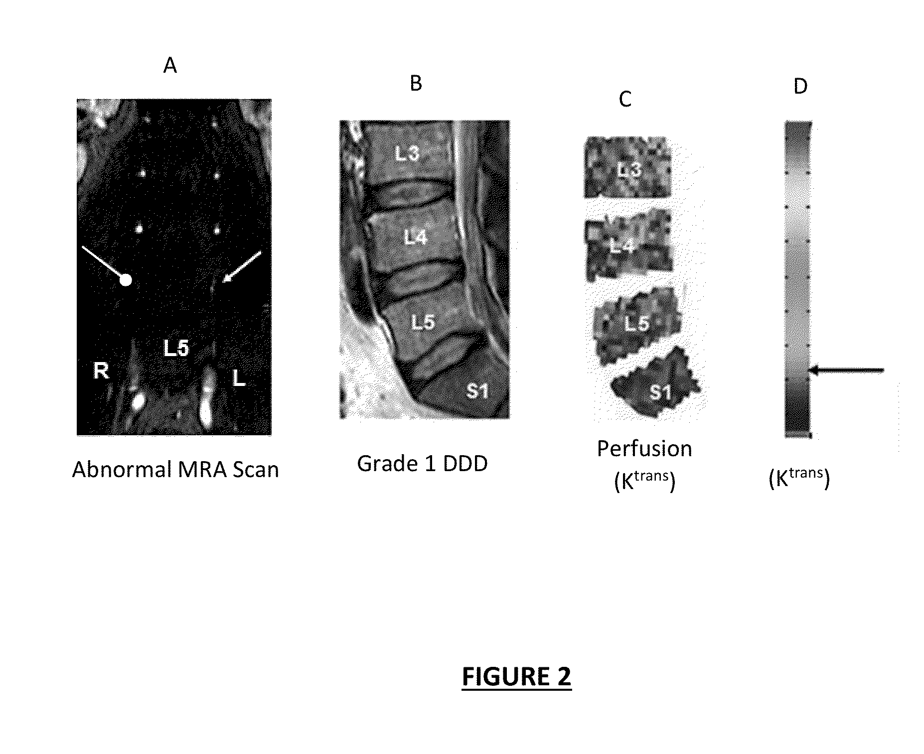 Therapeutic Angiogenesis for Treatment of the Spine and Other Tissues