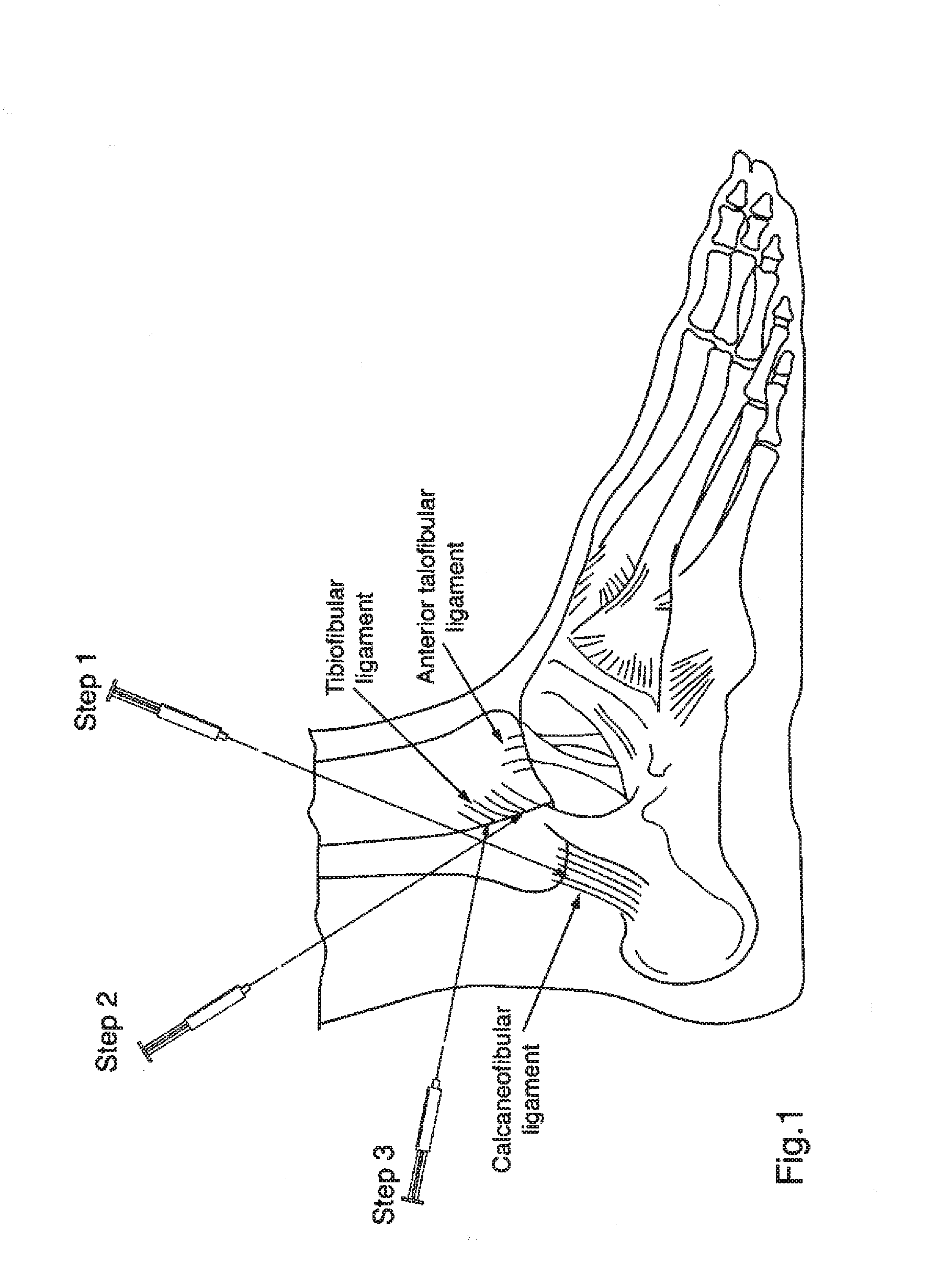 Treatment of soft tissue injury using hyaluronic acid and botulinum toxin