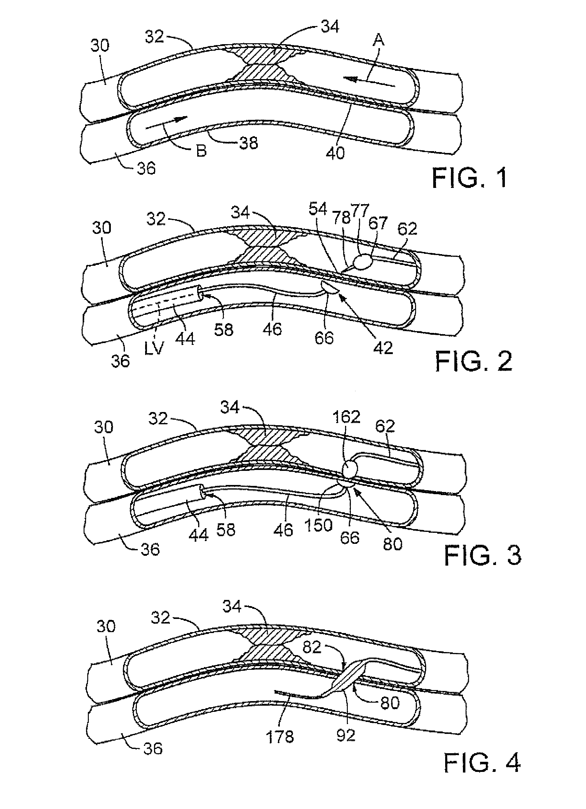 Catheter system with stent apparatus for connecting adjacent blood vessels