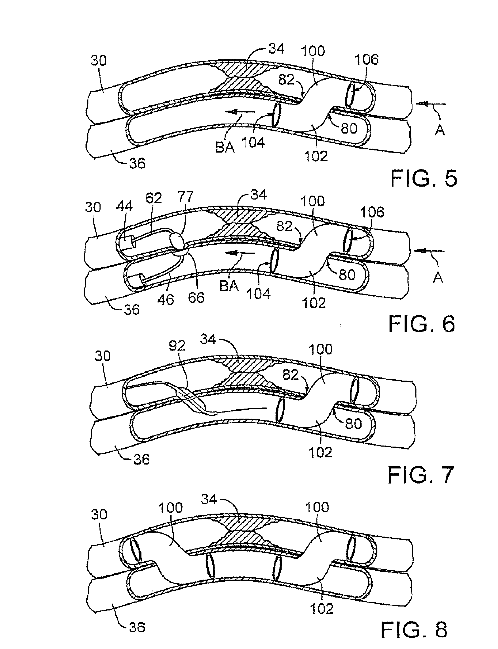 Catheter system with stent apparatus for connecting adjacent blood vessels