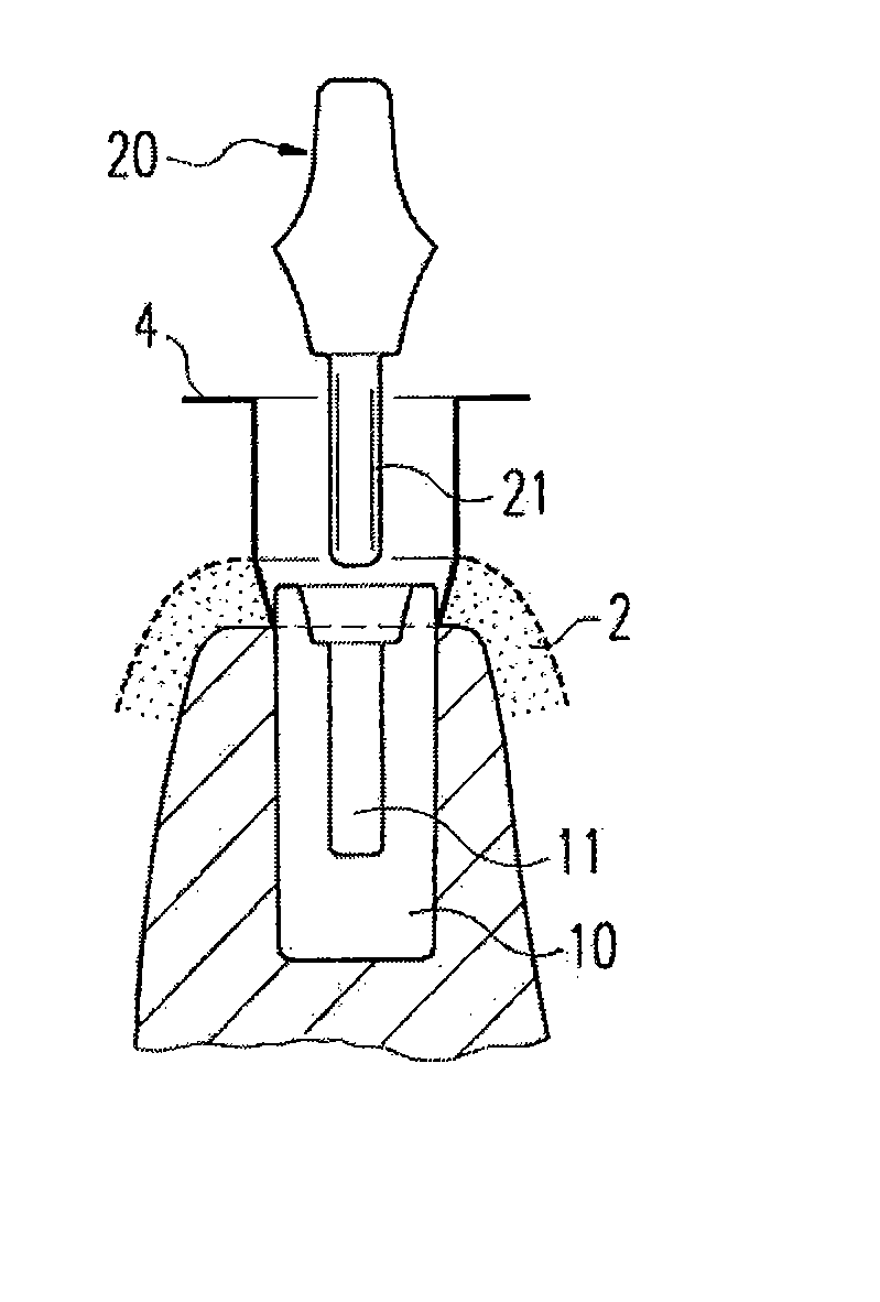 Zirconium Oxide-Based Dental Implant And Method For Producing Said Dental Implant