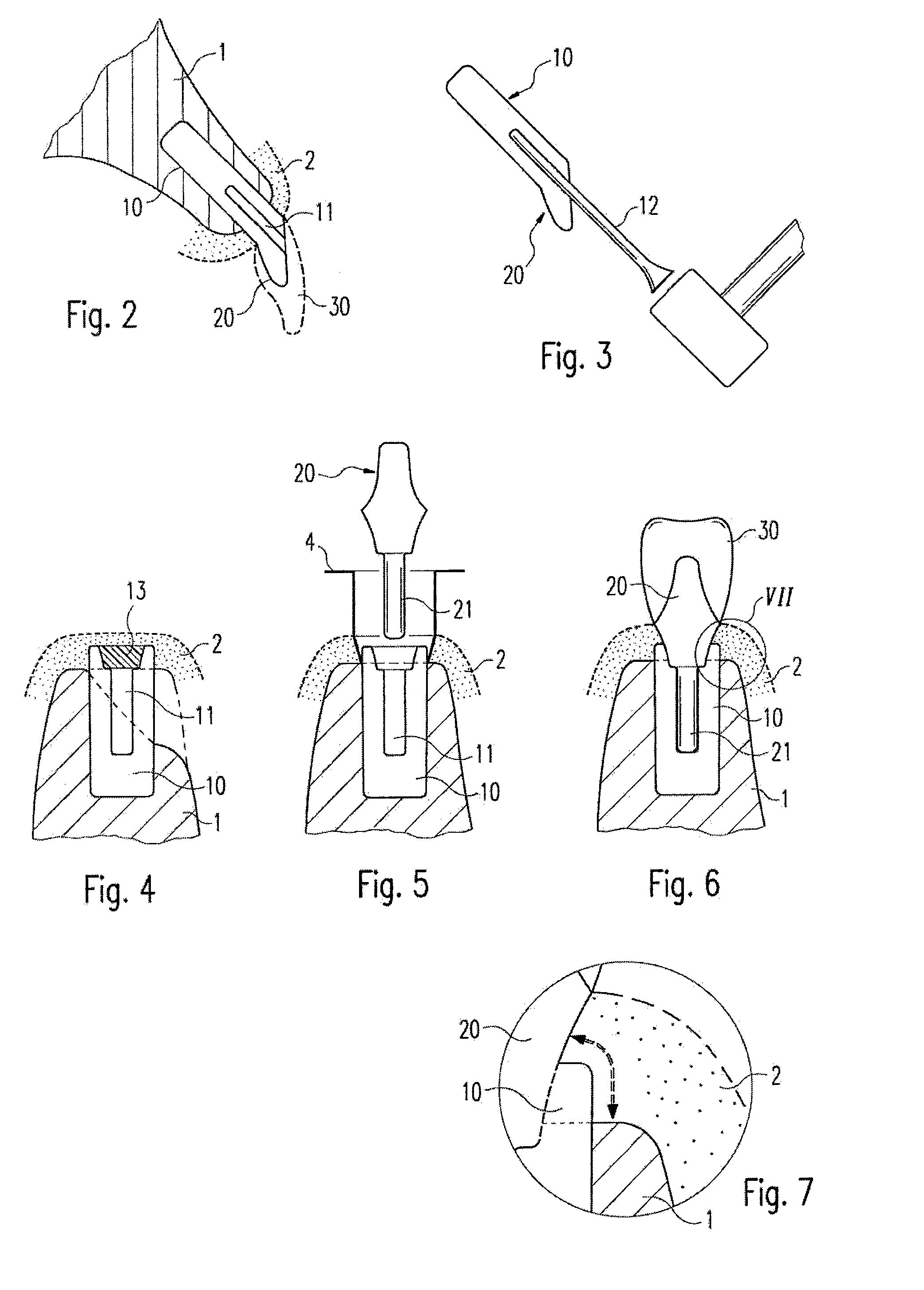 Zirconium Oxide-Based Dental Implant And Method For Producing Said Dental Implant