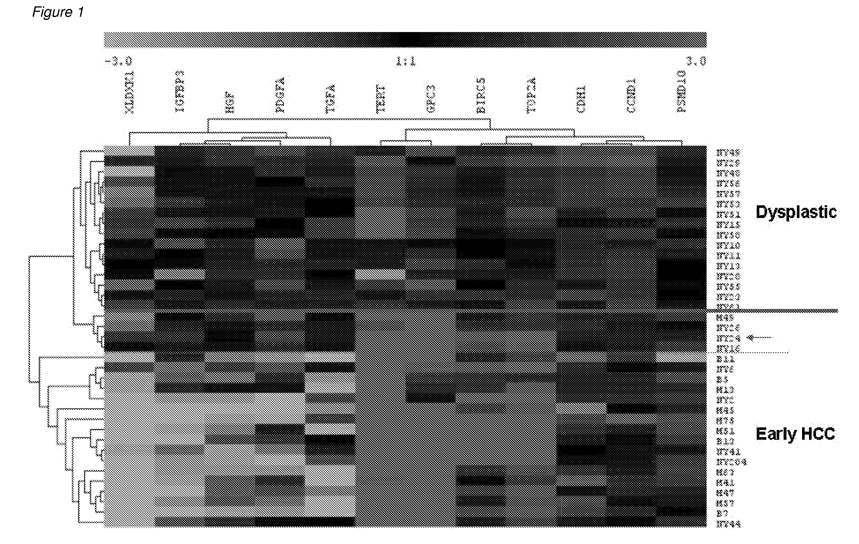 Methods and compositions for the diagnosis for early hepatocellular carcinoma