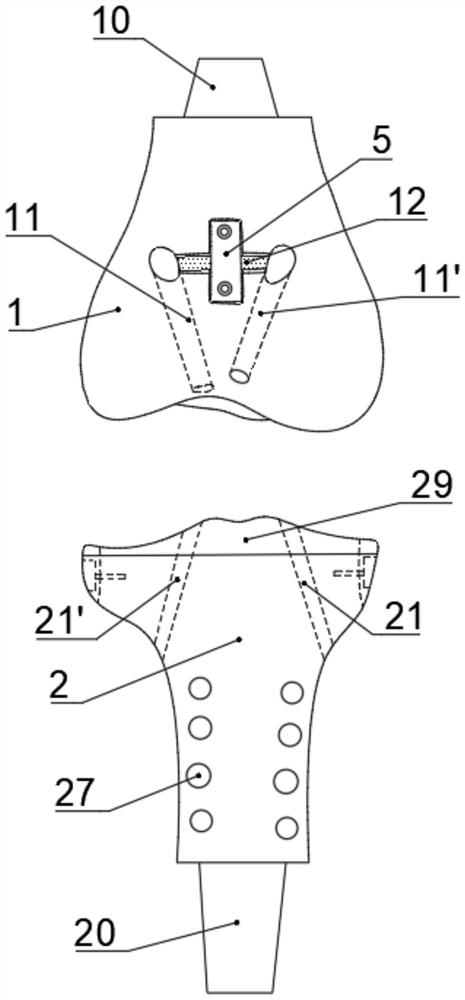 A hingeless ligament biomimetic tumor half/total knee joint prosthesis reconstruction system