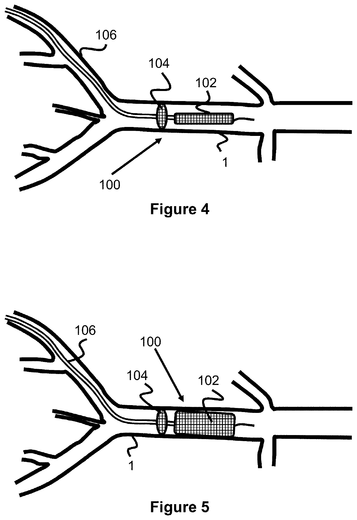 Temporary aortic occlusion device