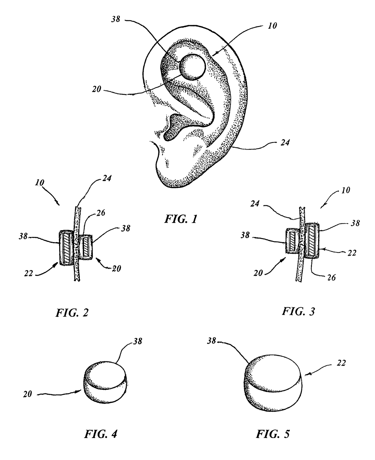 Pressure bearing auricular hematoma appliance