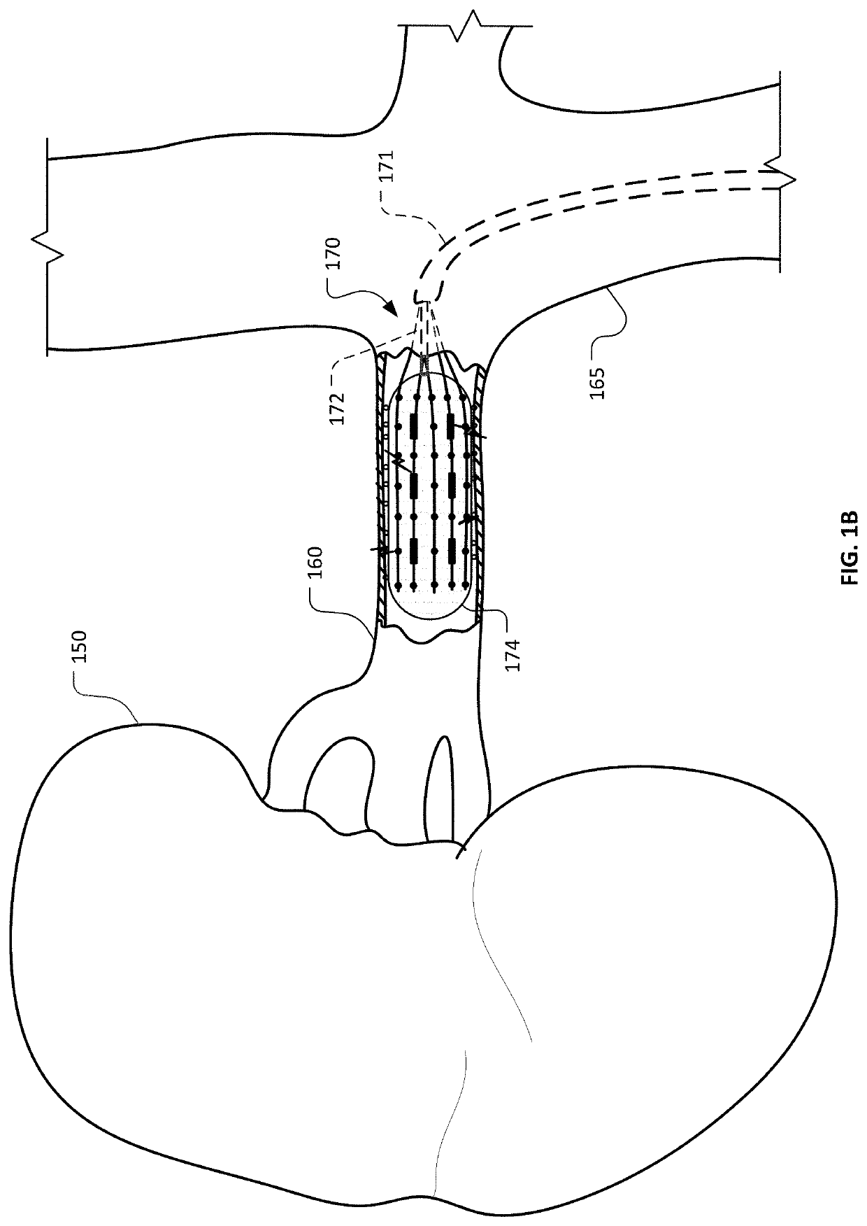 Devices and methods for ablation of tissue