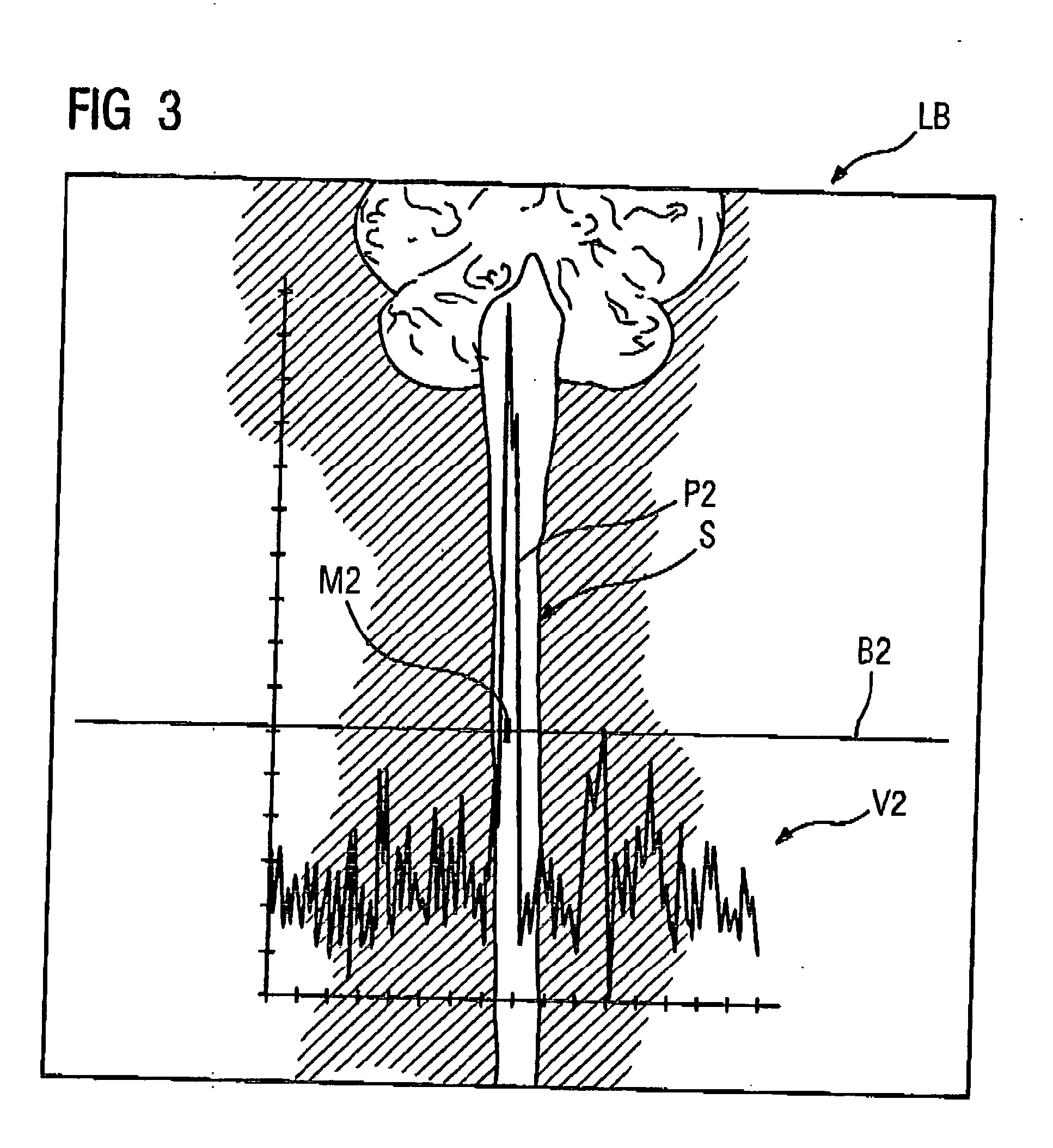 Method and magnetic resonance imaging apparatus for automatically determining the sagittal plane of a subject