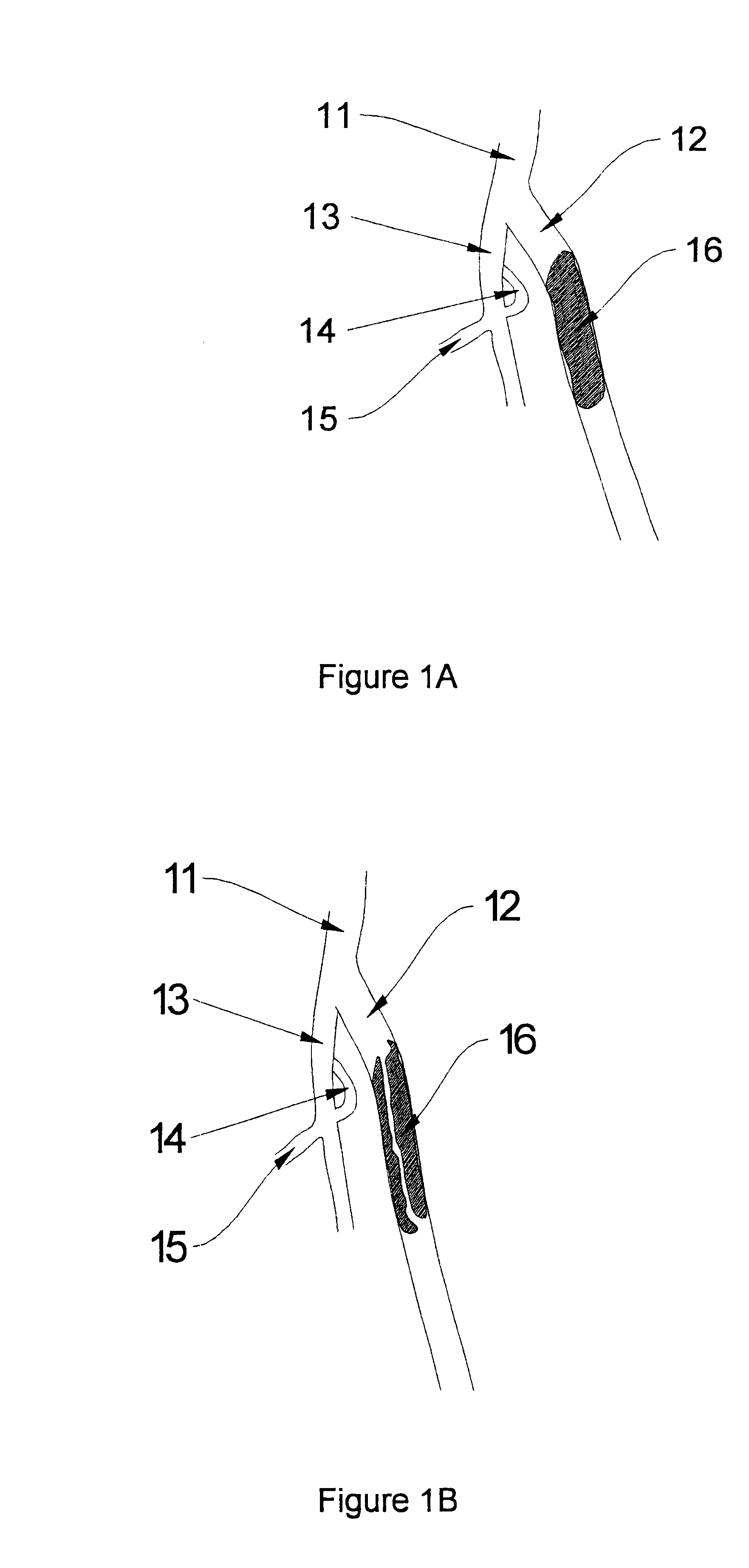 Methods for enhancing fluid flow through an obstructed vascular site, and systems and kits for use in practicing the same