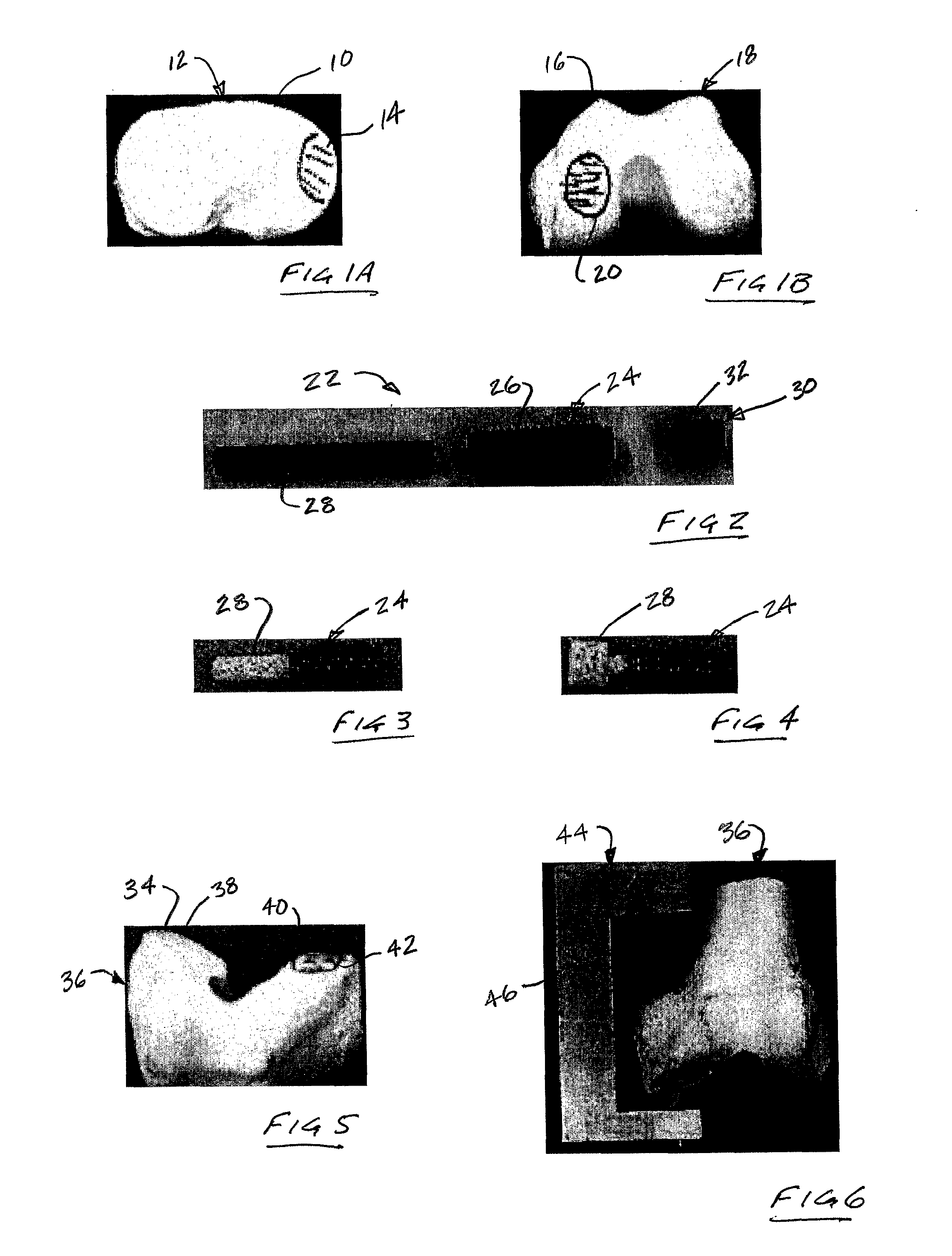 System and Method for Joint Restoration by Extracapsular Means