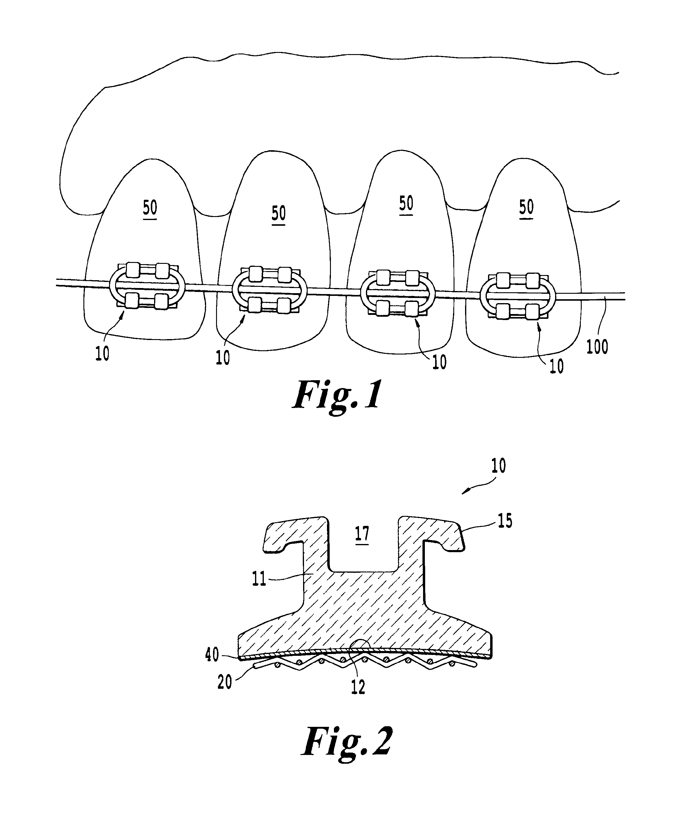 Metal mesh on ceramic bracket; ceramic bracket with metal insert; metal bracket with tooth-colored coating; self-legating, low profile, metal bracket; and methods of making same