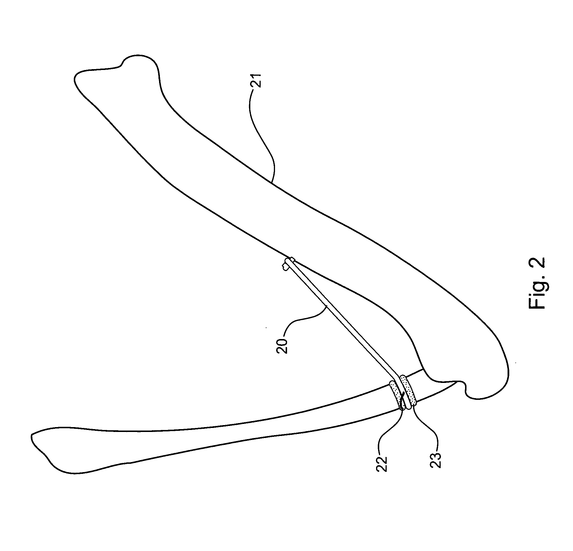 Electroactive polymer actuation of implants