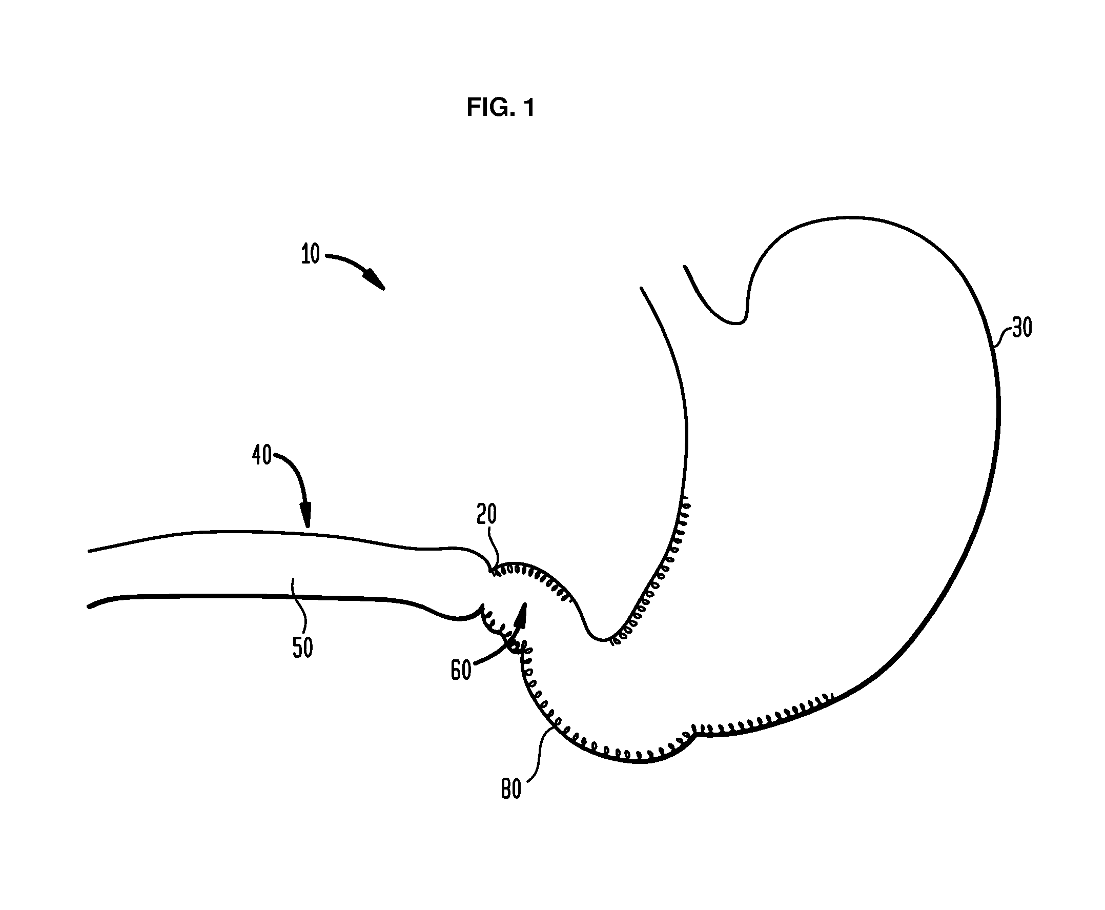 Systems and Methods for Treatment of Obesity and Type 2 Diabetes