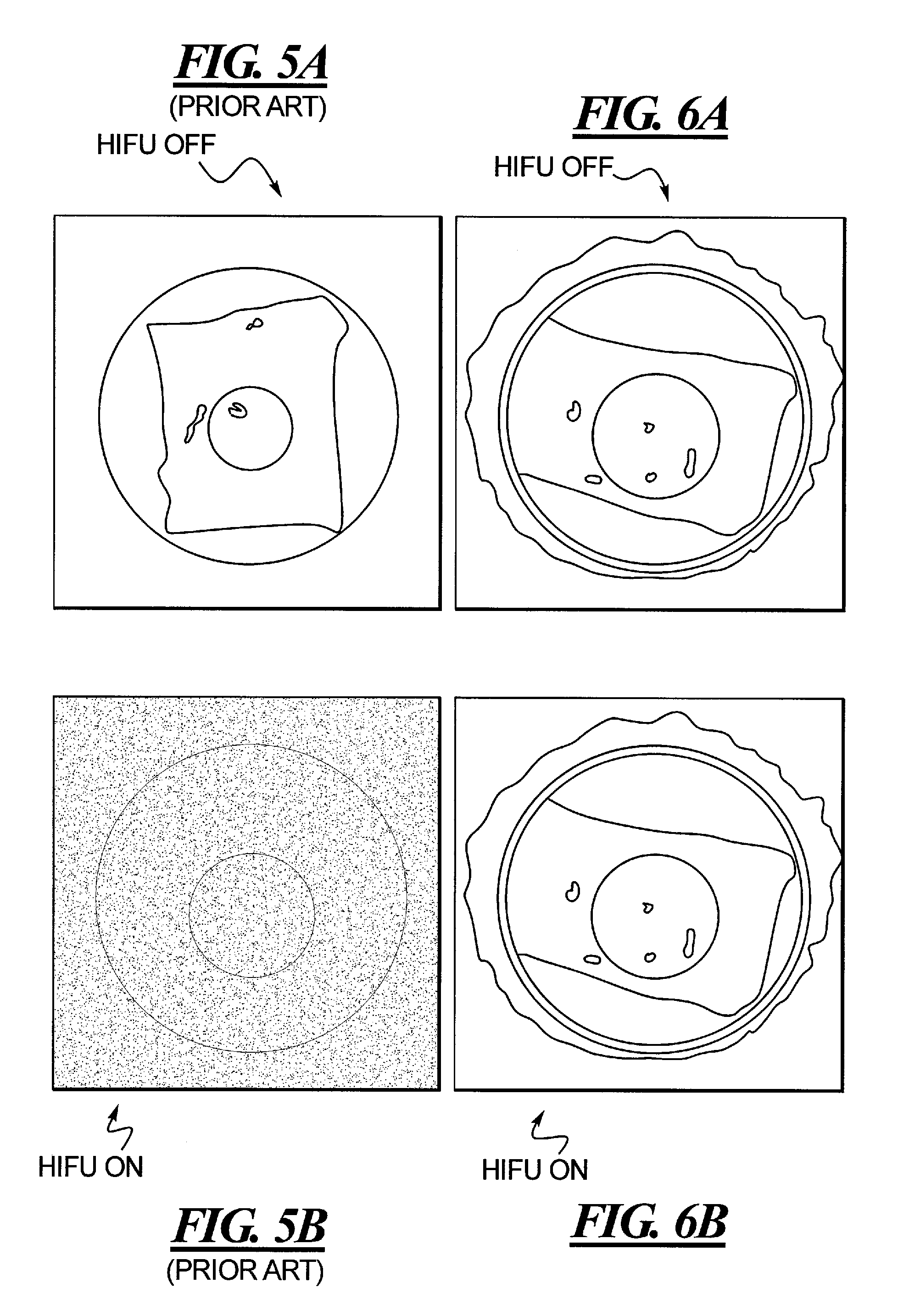 Hifu-compatible reception coil for MRI RF signals and signal receiving method