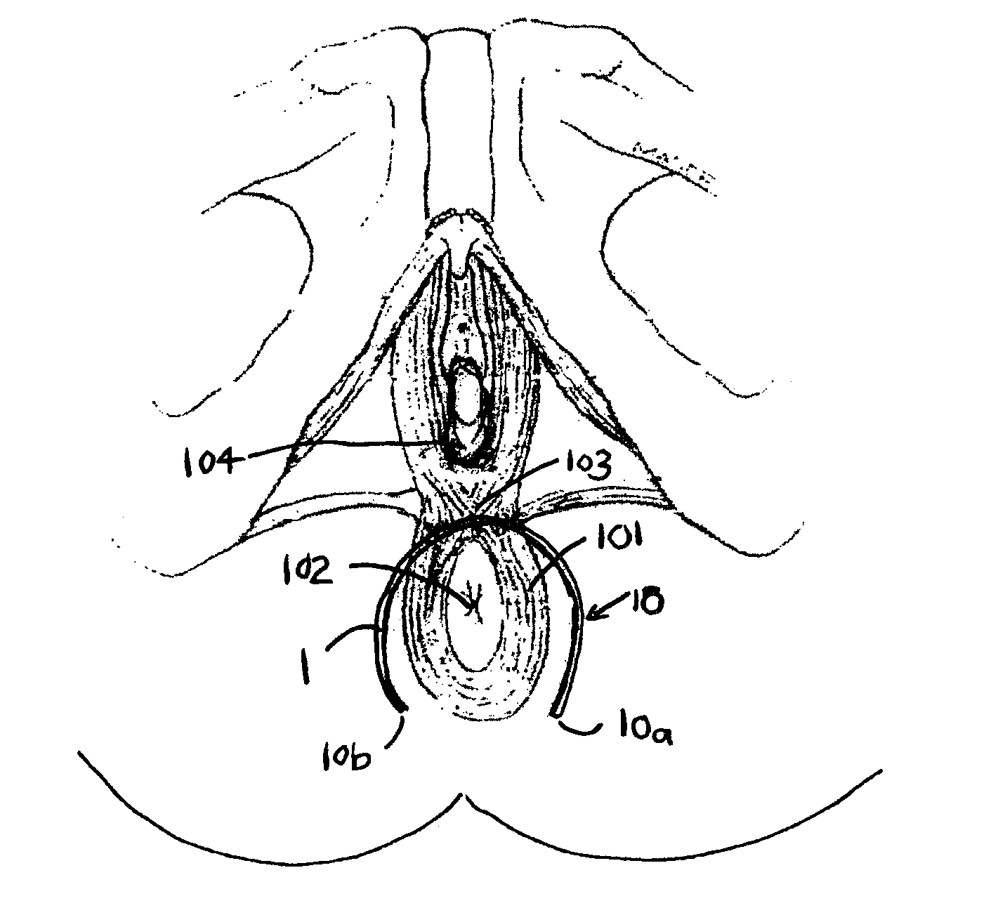 Method of treating anal incontinence