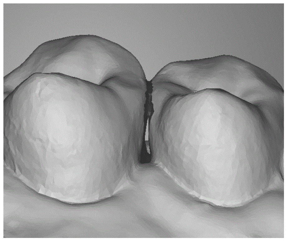 Automatic detection and repairing method of dentulous jaw black triangle