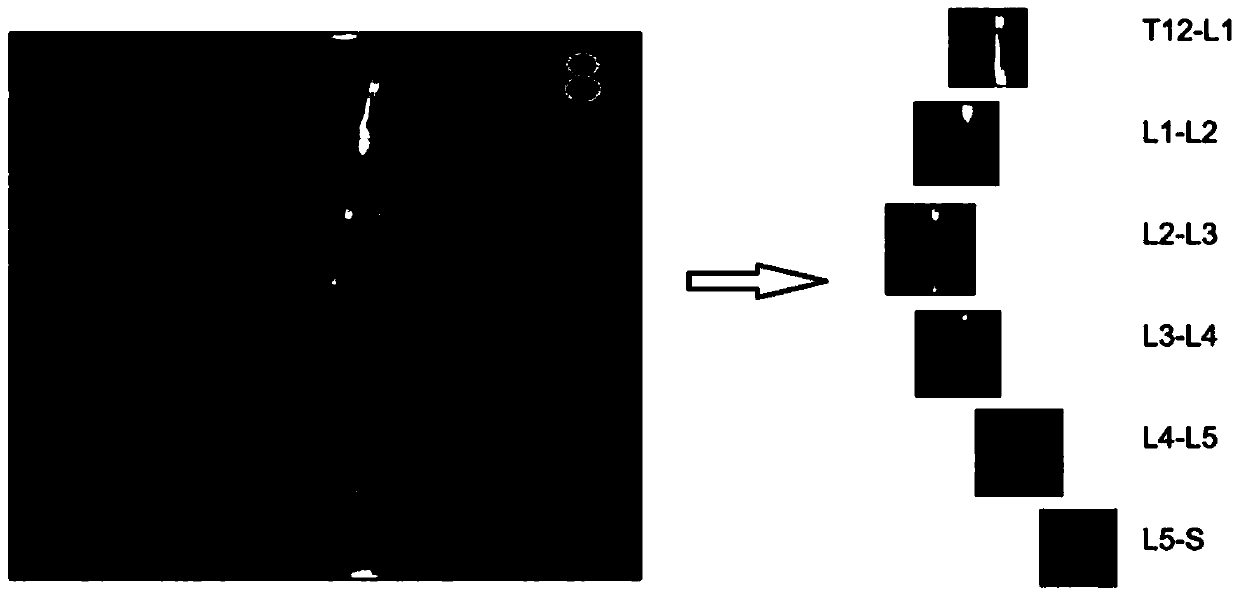 Artificial intelligence diagnosis and classification system for lumbar disc herniation