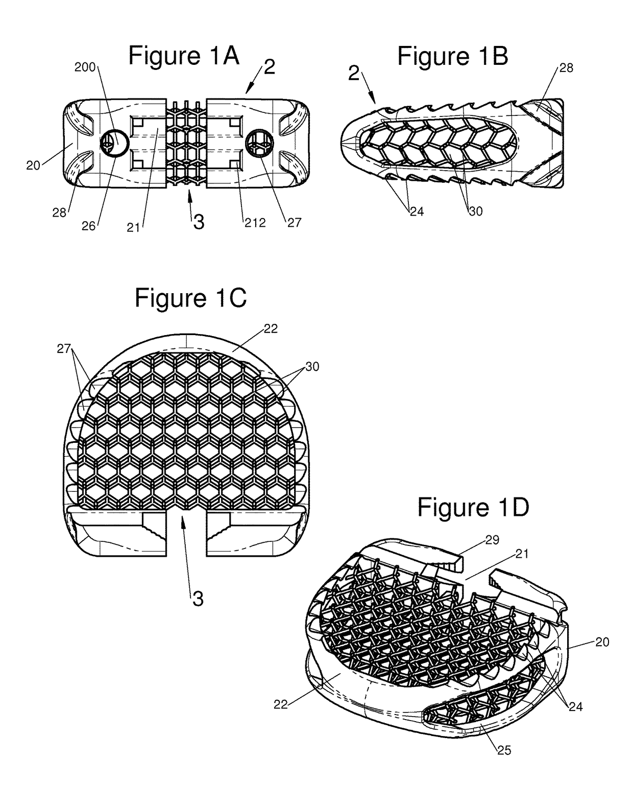 Vertebral System, Implant and Inserts for Vertebral System