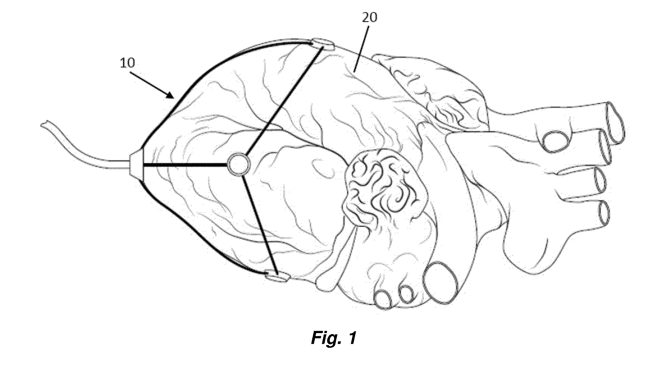 Deployable Polygonal Manipulator for Minimally Invasive Surgical Interventions