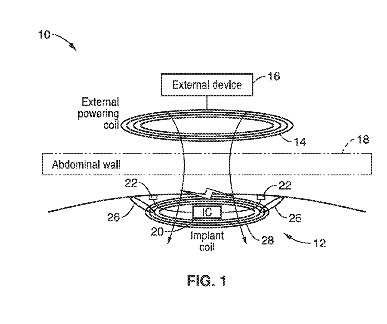 Disposable gastrointestinal implantable stimulator