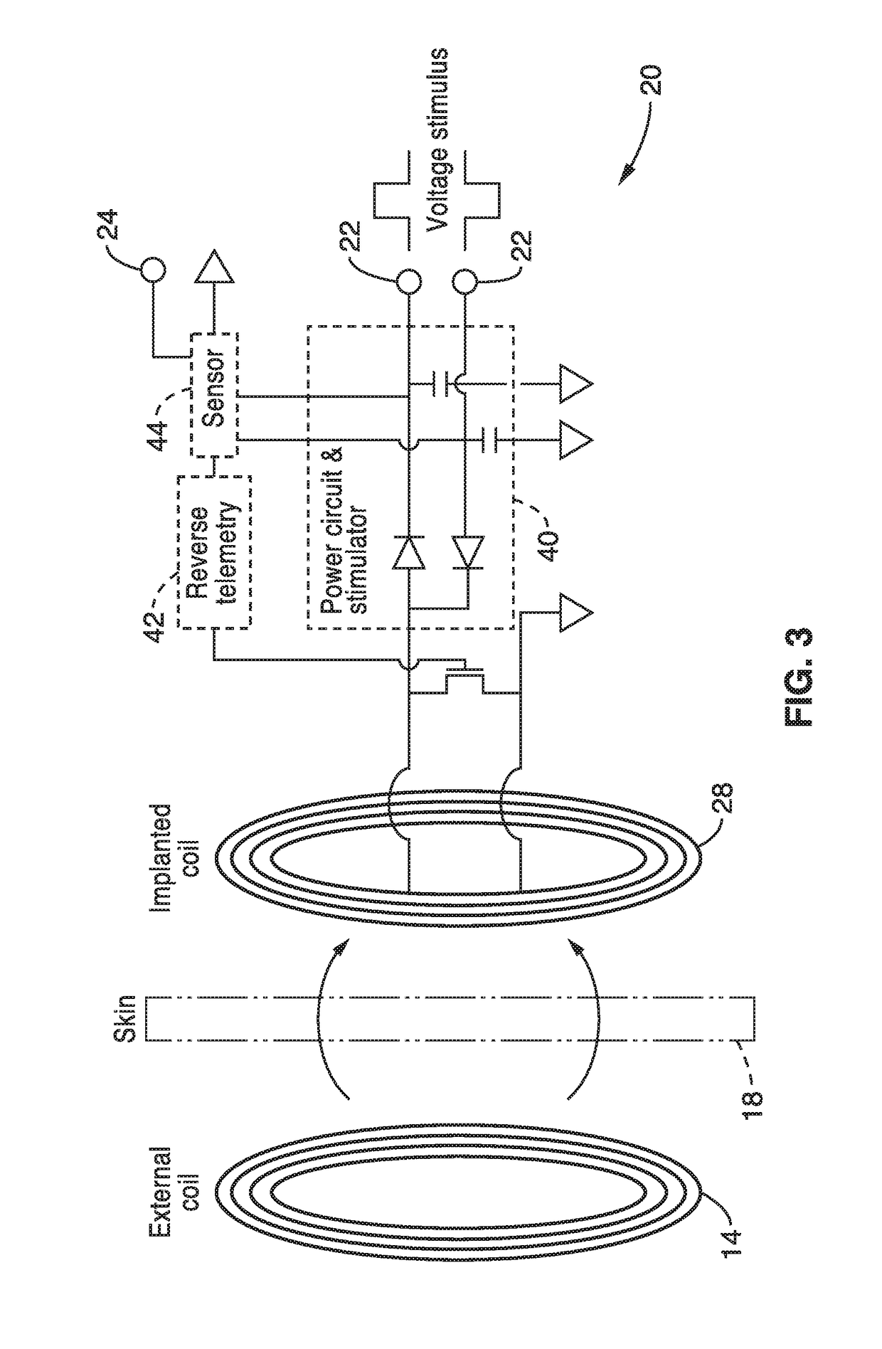 Disposable gastrointestinal implantable stimulator