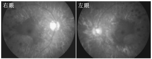 A pathogenic mutation of hereditary retinitis pigmentosa and its detection reagent