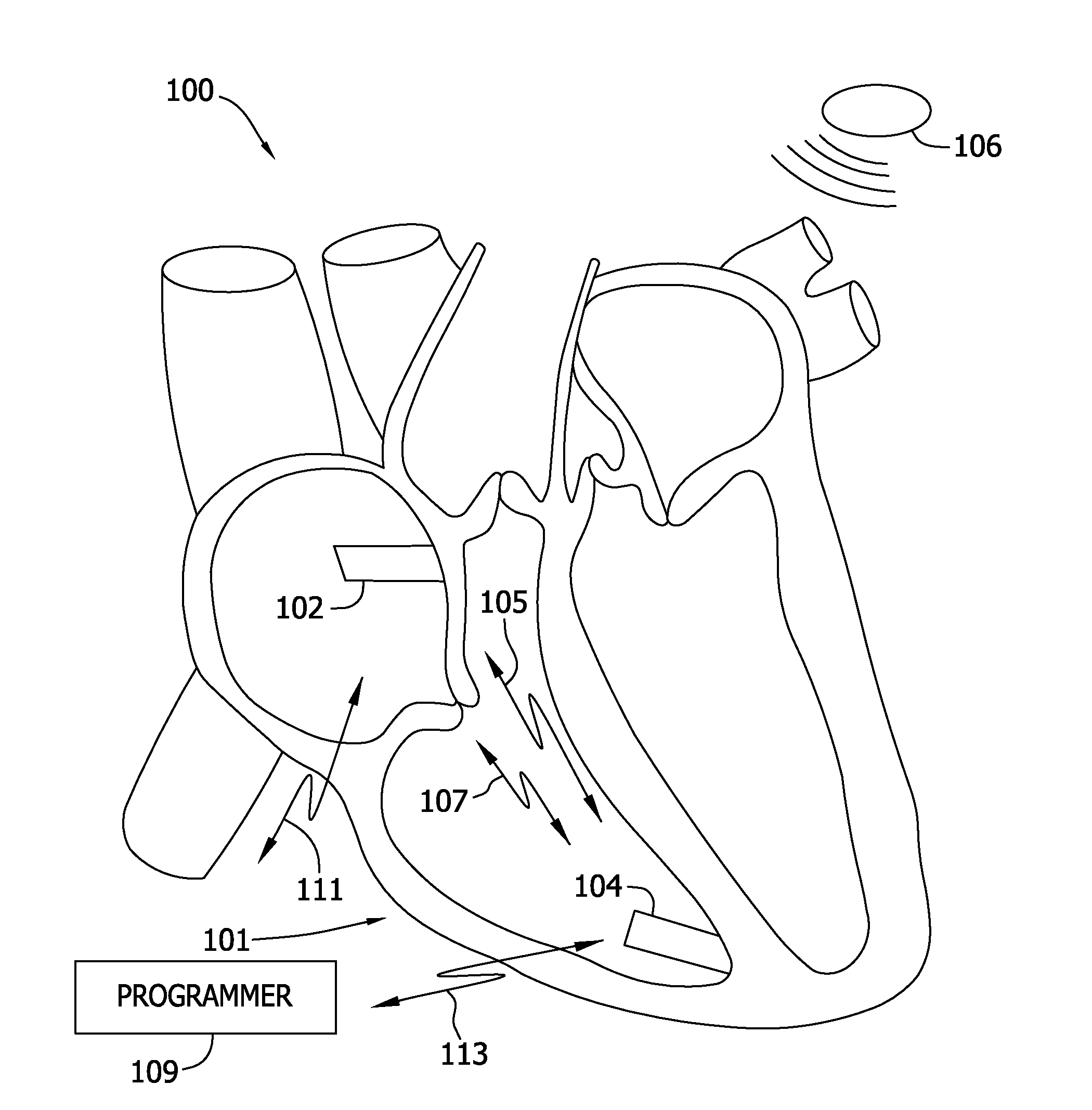 Dual chamber leadless pacemaker programmer and method