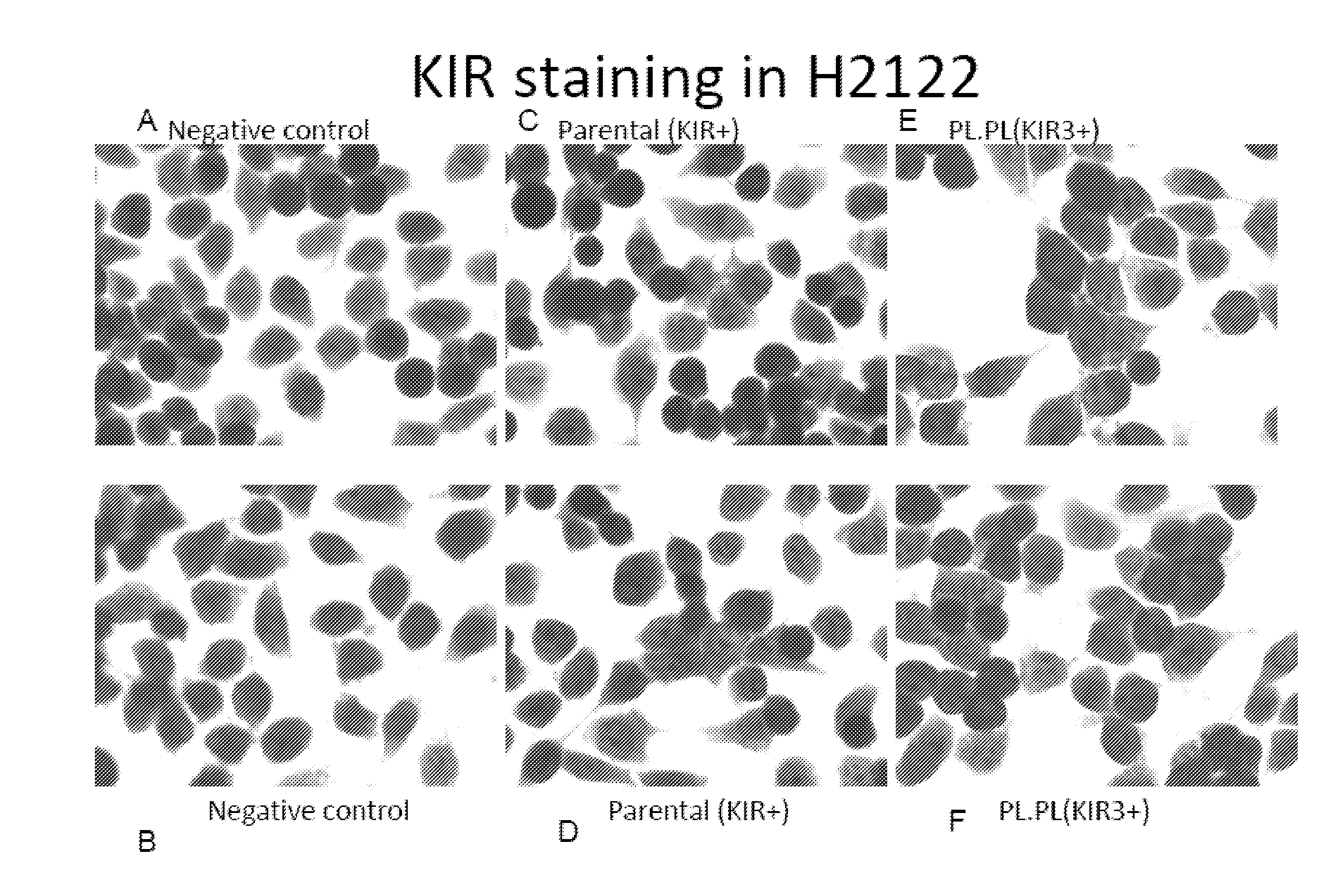 Expression of kir in human cancer cells as a biomarker for immuno-escape and cancer metastasis