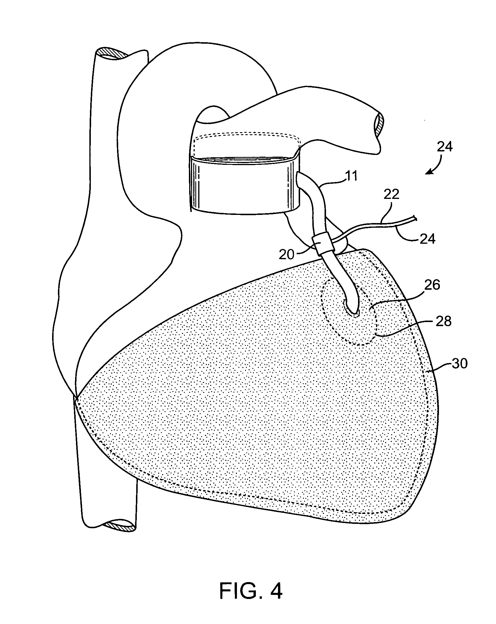 Devices and methods for absorbing, transferring and delivering heart energy