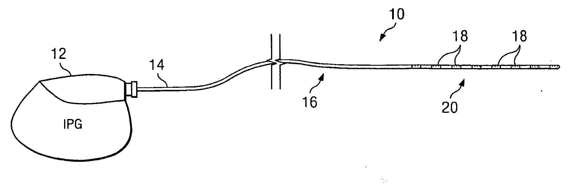 System and method for neurological stimulation of peripheral nerves to treat low back pain