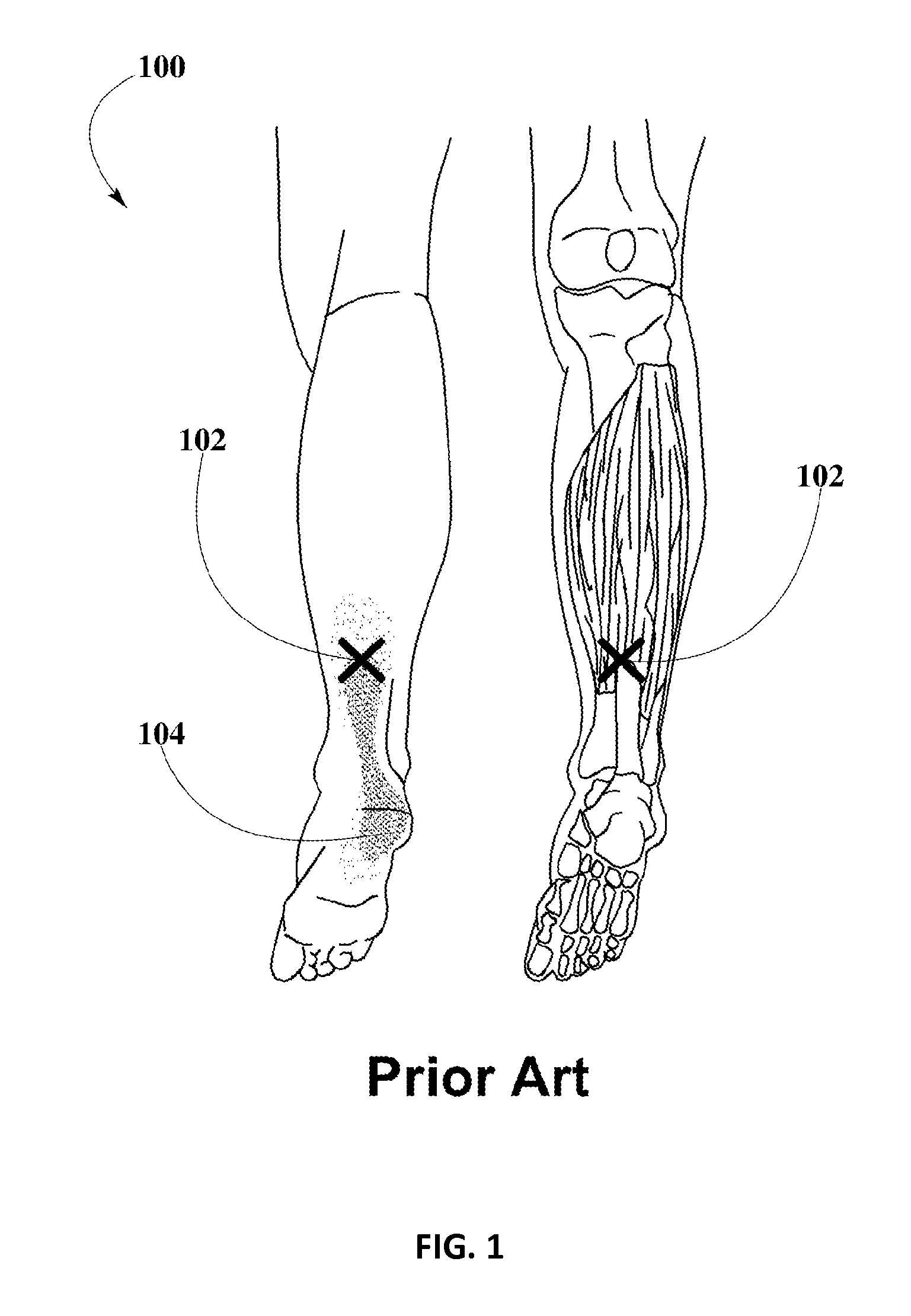 Piroxicam Transdermal Composition to Treat Plantar Fasciitis