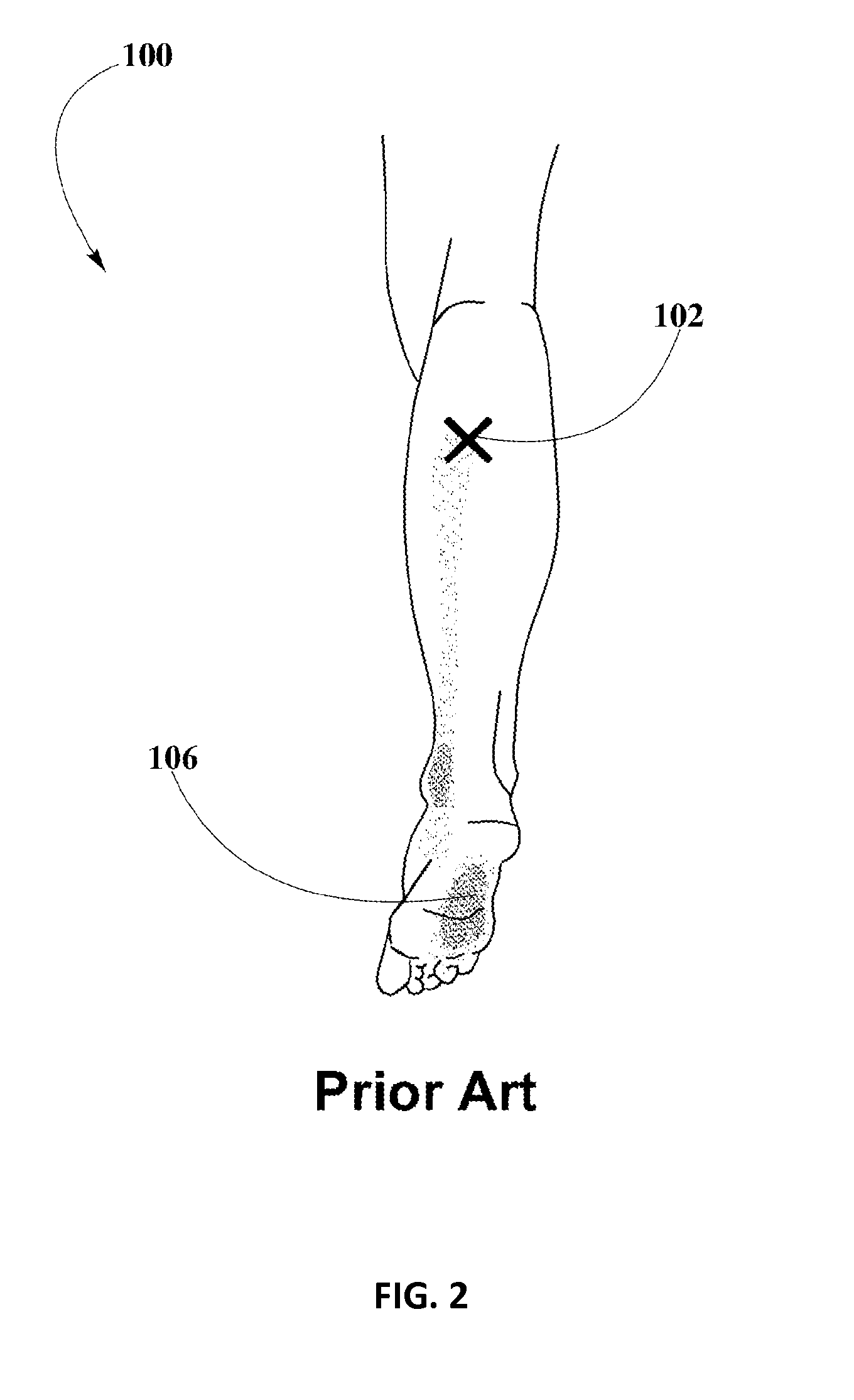 Piroxicam Transdermal Composition to Treat Plantar Fasciitis