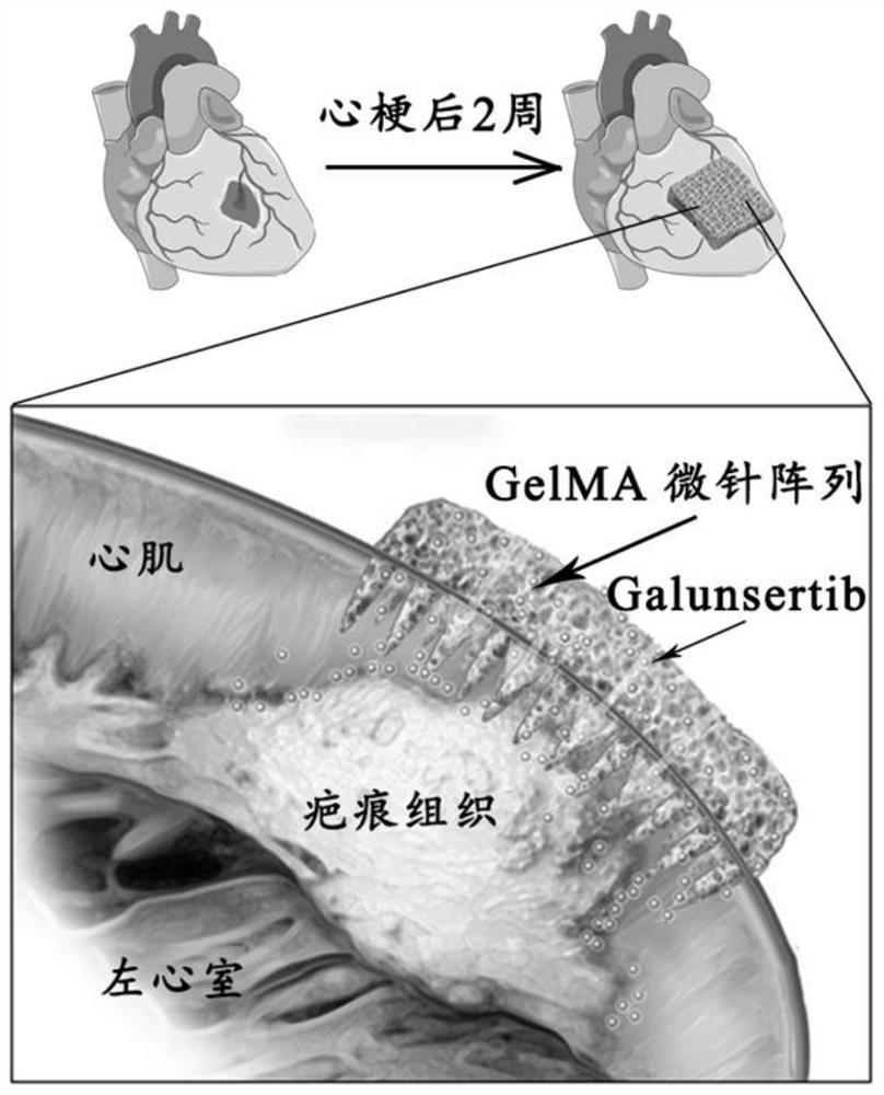 Heart microneedle patch loaded with TGF (Transforming Growth Factor)-beta inhibitor Galunsertib, and preparation method of heart microneedle patch