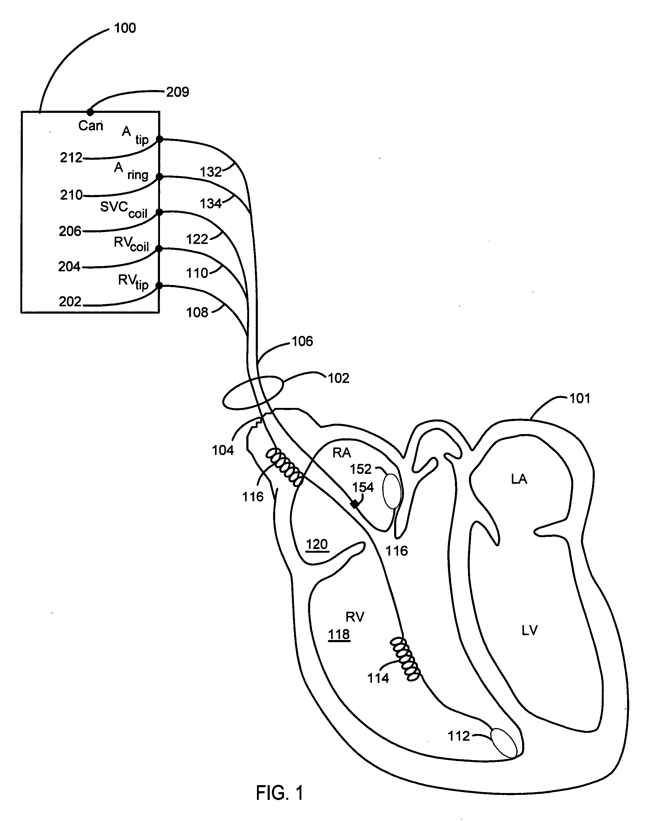 Method and system for detecting capture with cancellation of pacing artifact