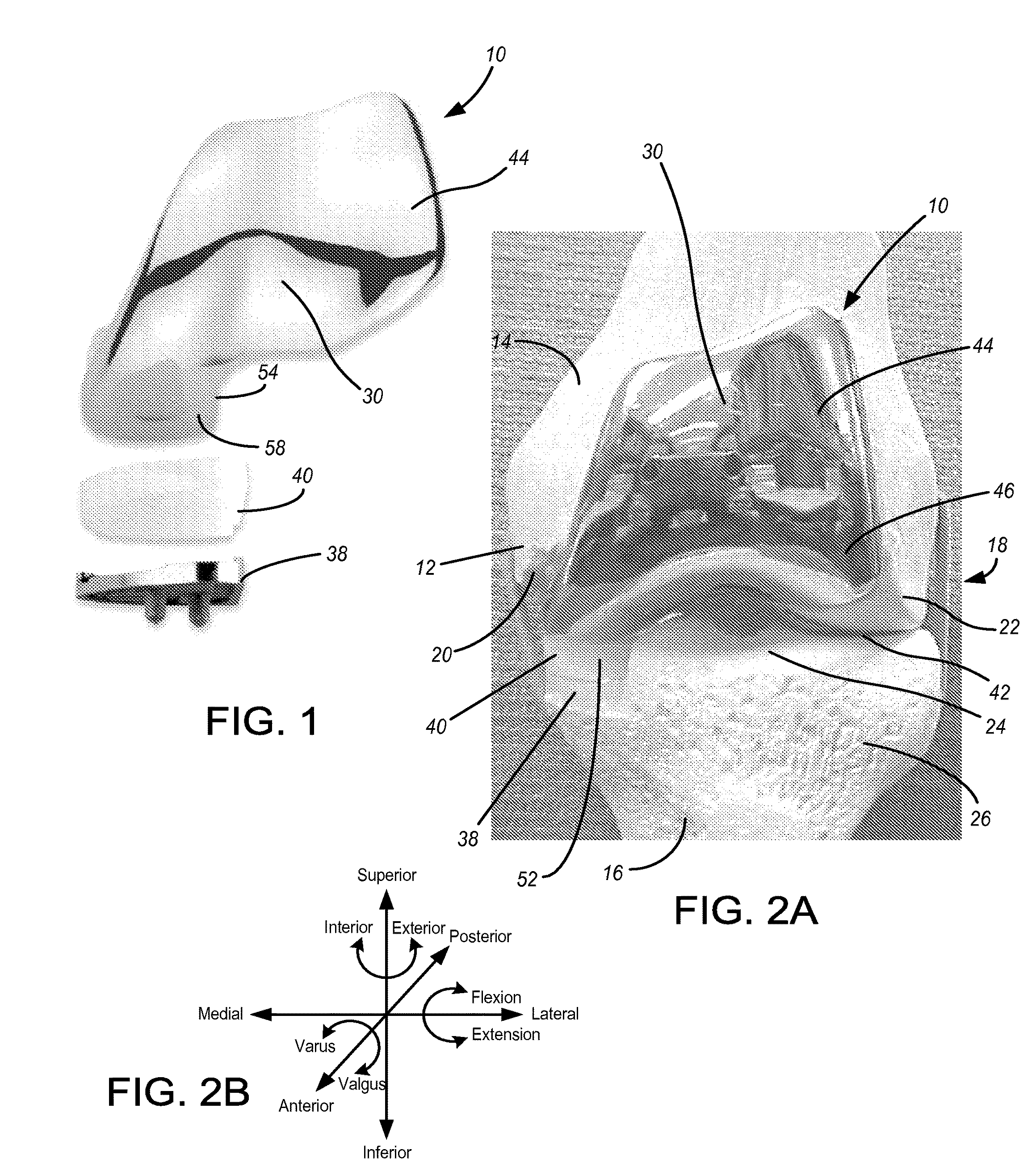 Implants with transition surfaces and related processes