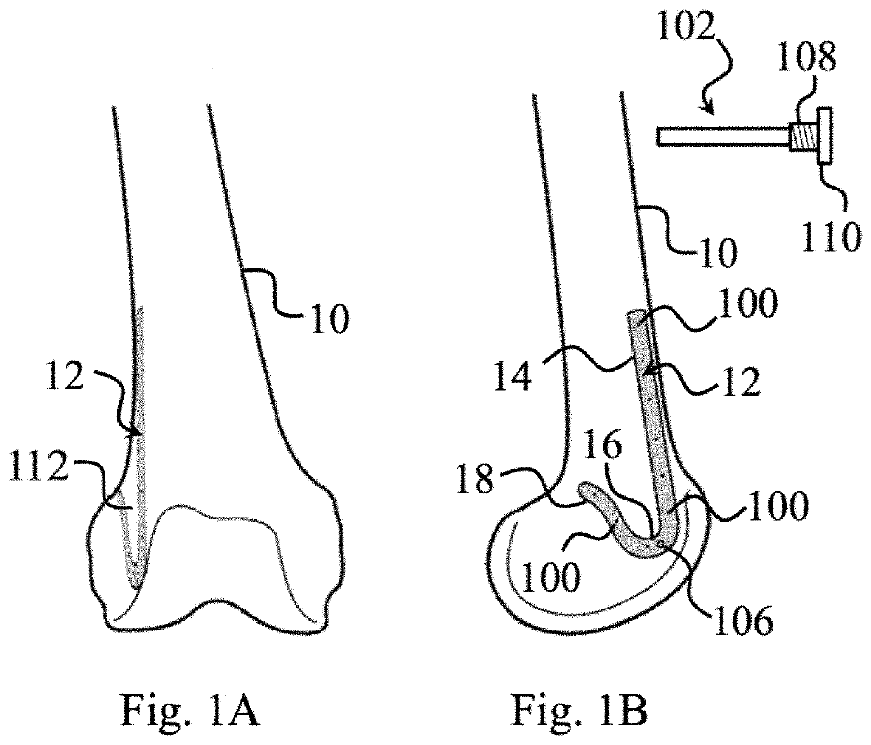 Plating System For Repair of Femur Fractures