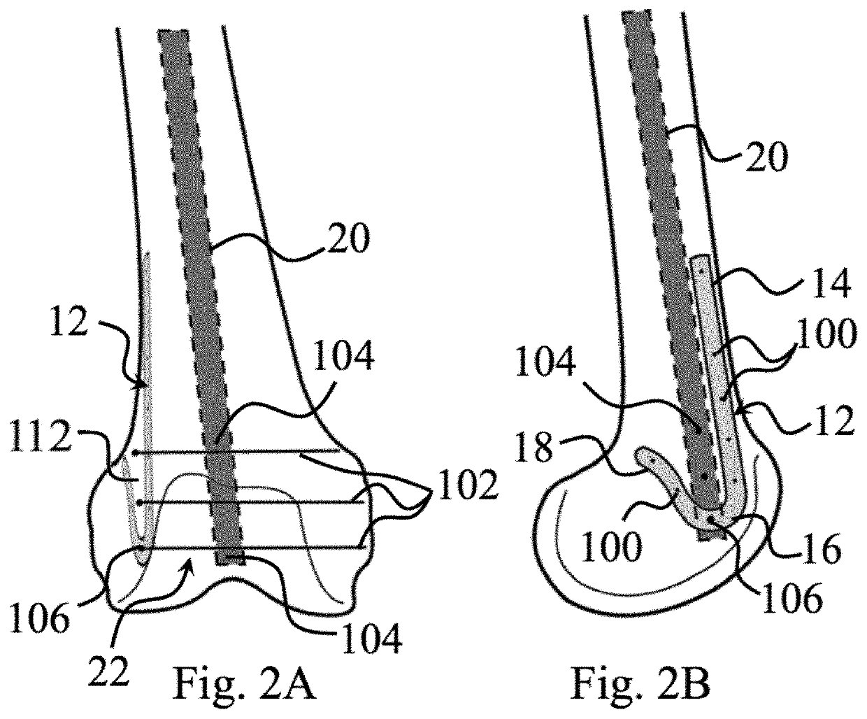 Plating System For Repair of Femur Fractures