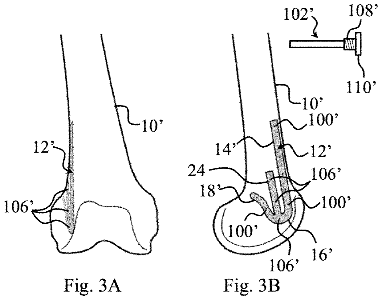 Plating System For Repair of Femur Fractures