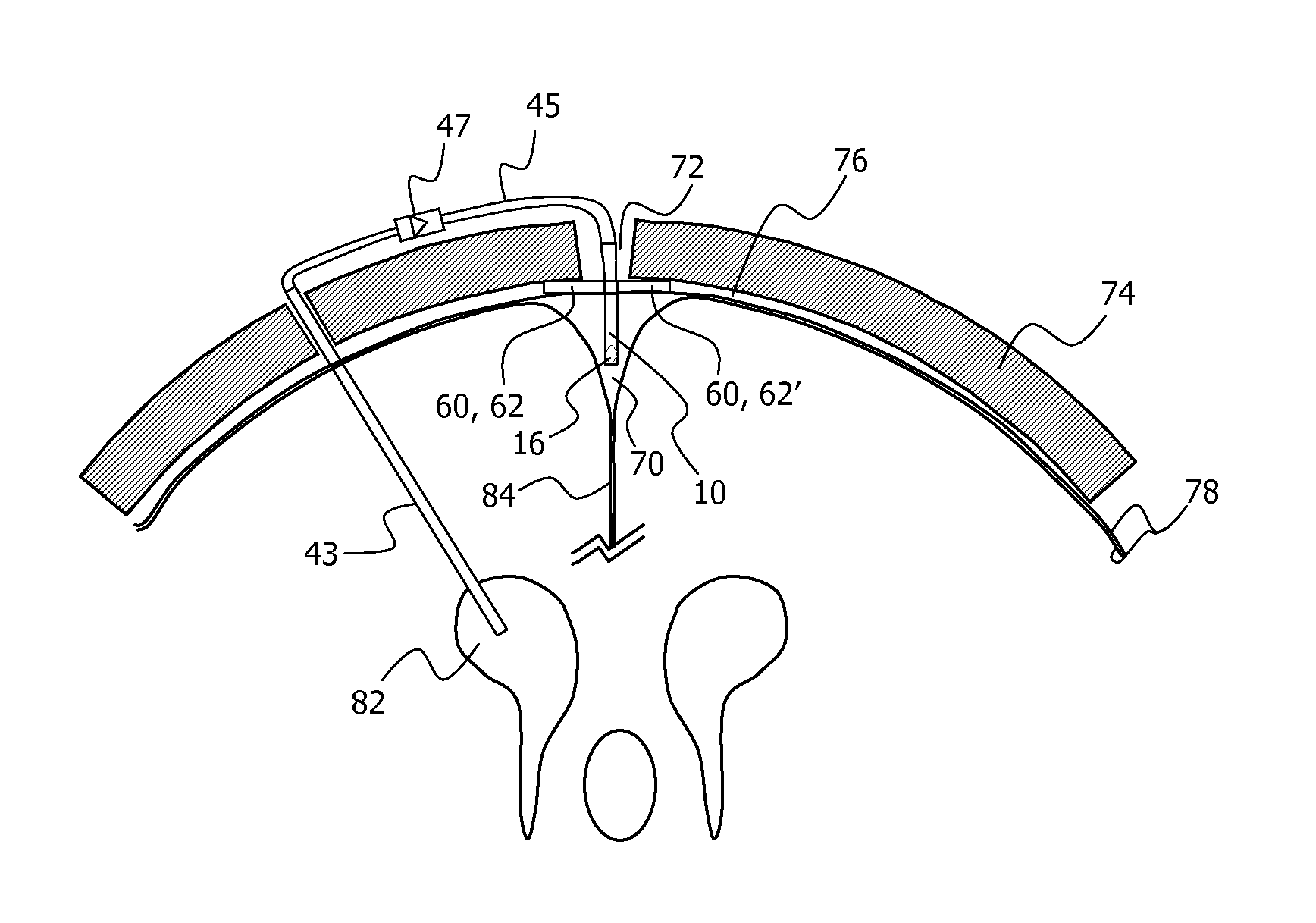 Minimally-advancing luminal catheter