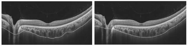 Choroid three-dimensional blood vessel imaging and quantitative analysis method and device based on optical coherence tomography system