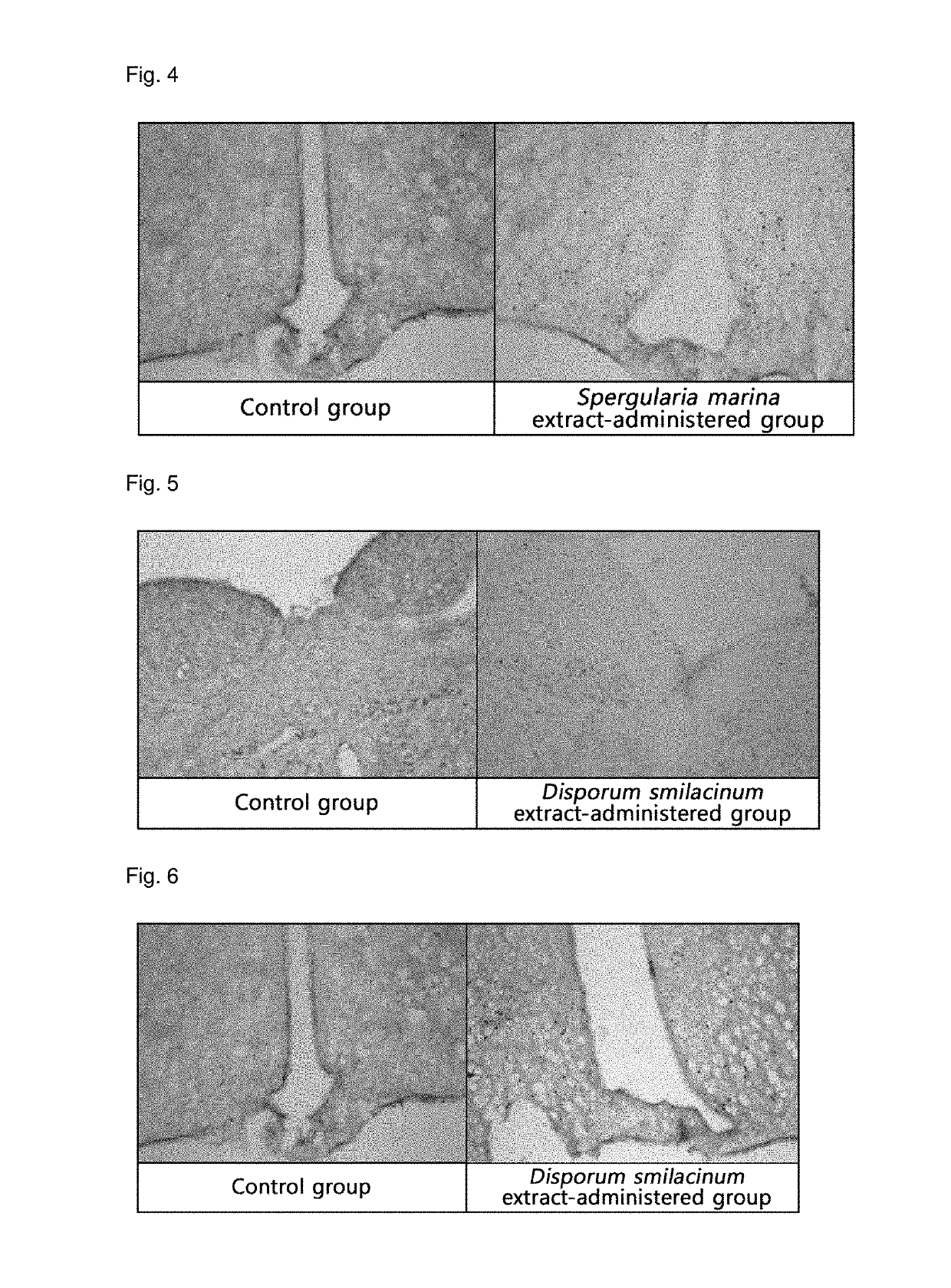 Pharmaceutical or food composition comprising <i>Oldenlandia brachypoda</i>, <i>Spergularia marina</i>, <i>Disporum smilacinum</i>, <i>Persicaria posumbu</i>, or <i>Geum aleppicum</i>