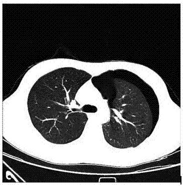 Lung pneumothorax CT image classified diagnosis method based on machine learning