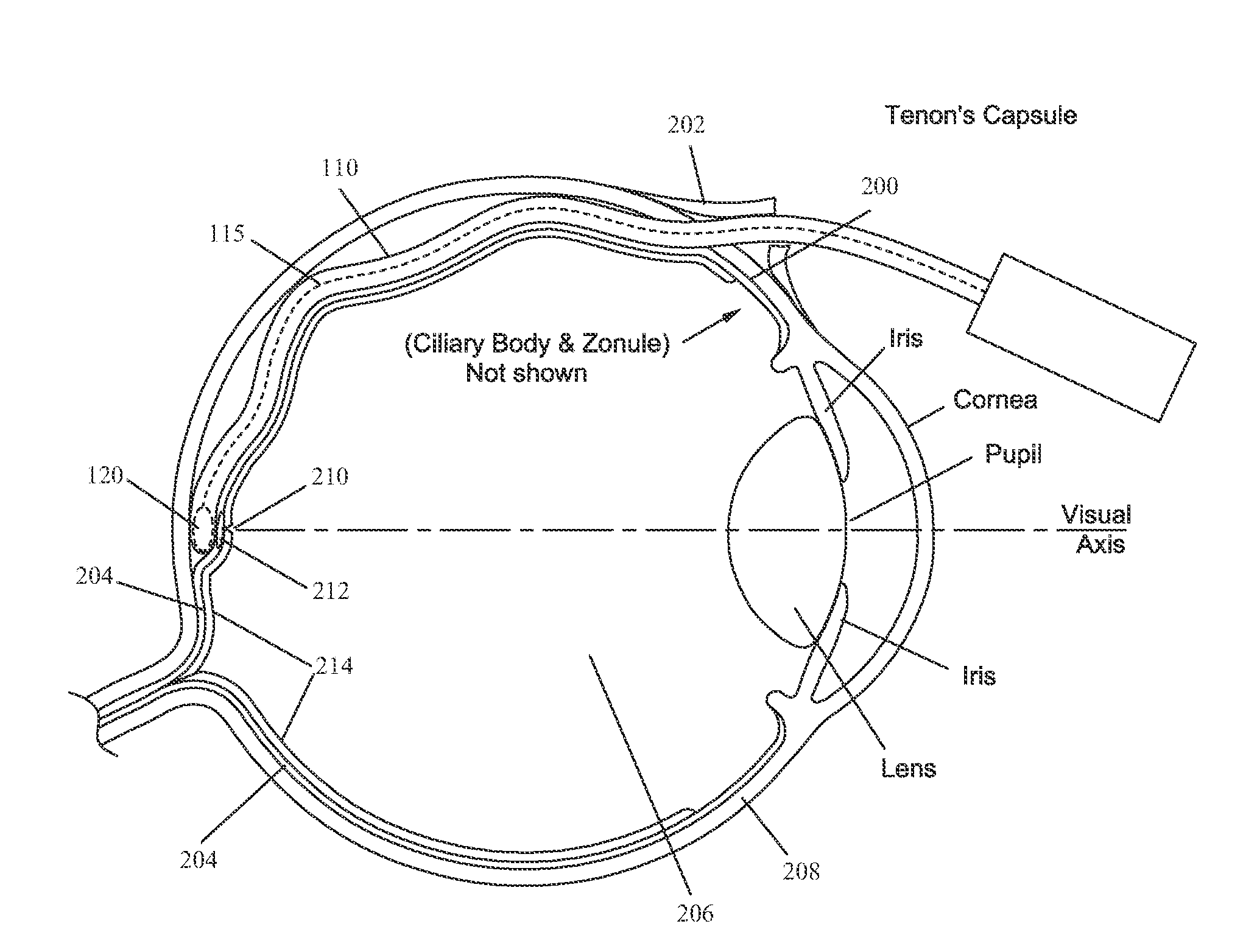 Methods and devices for delivery of radiation to the posterior portion of the eye