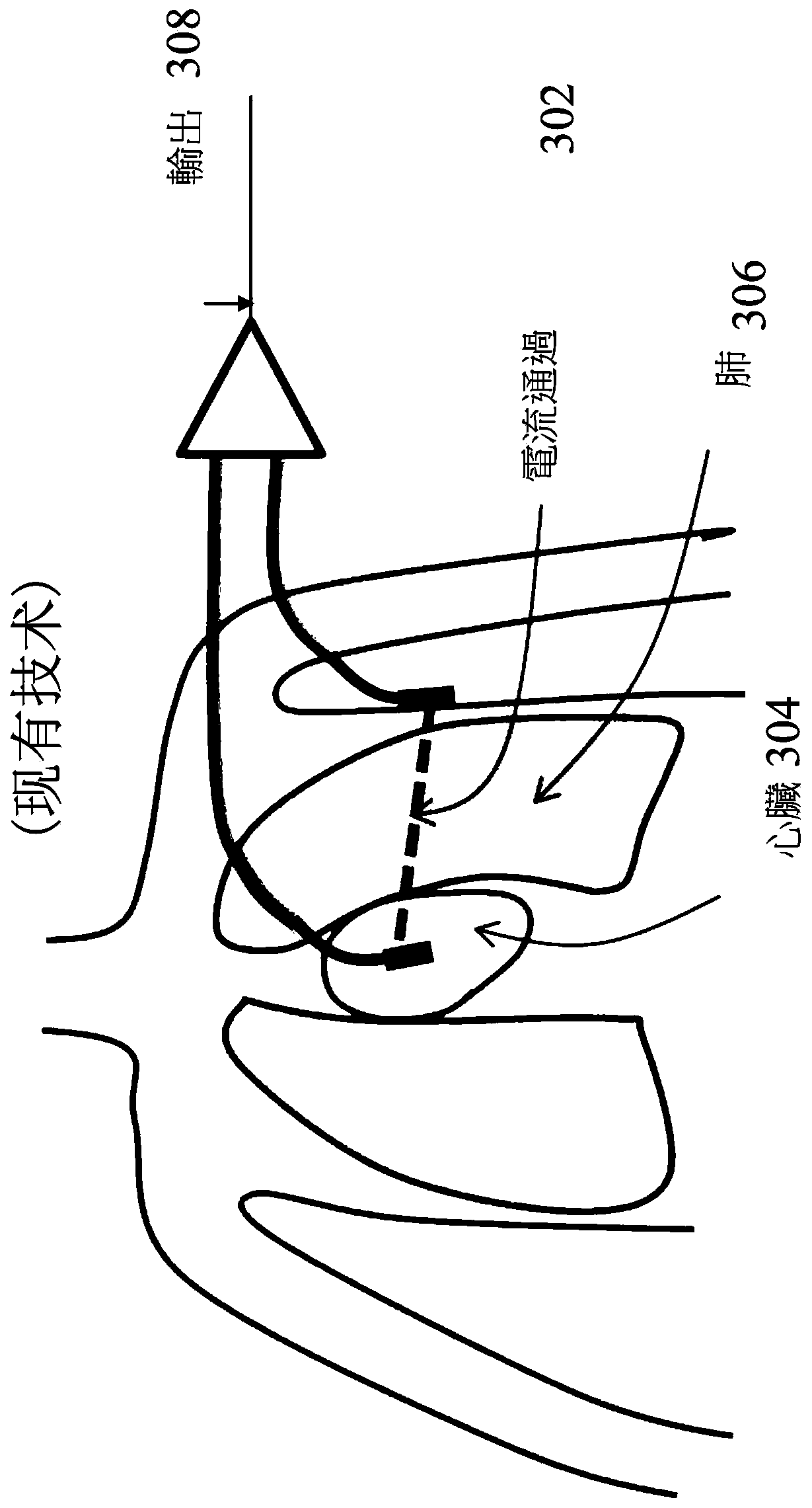 Systems and methods for sensing lung fluid