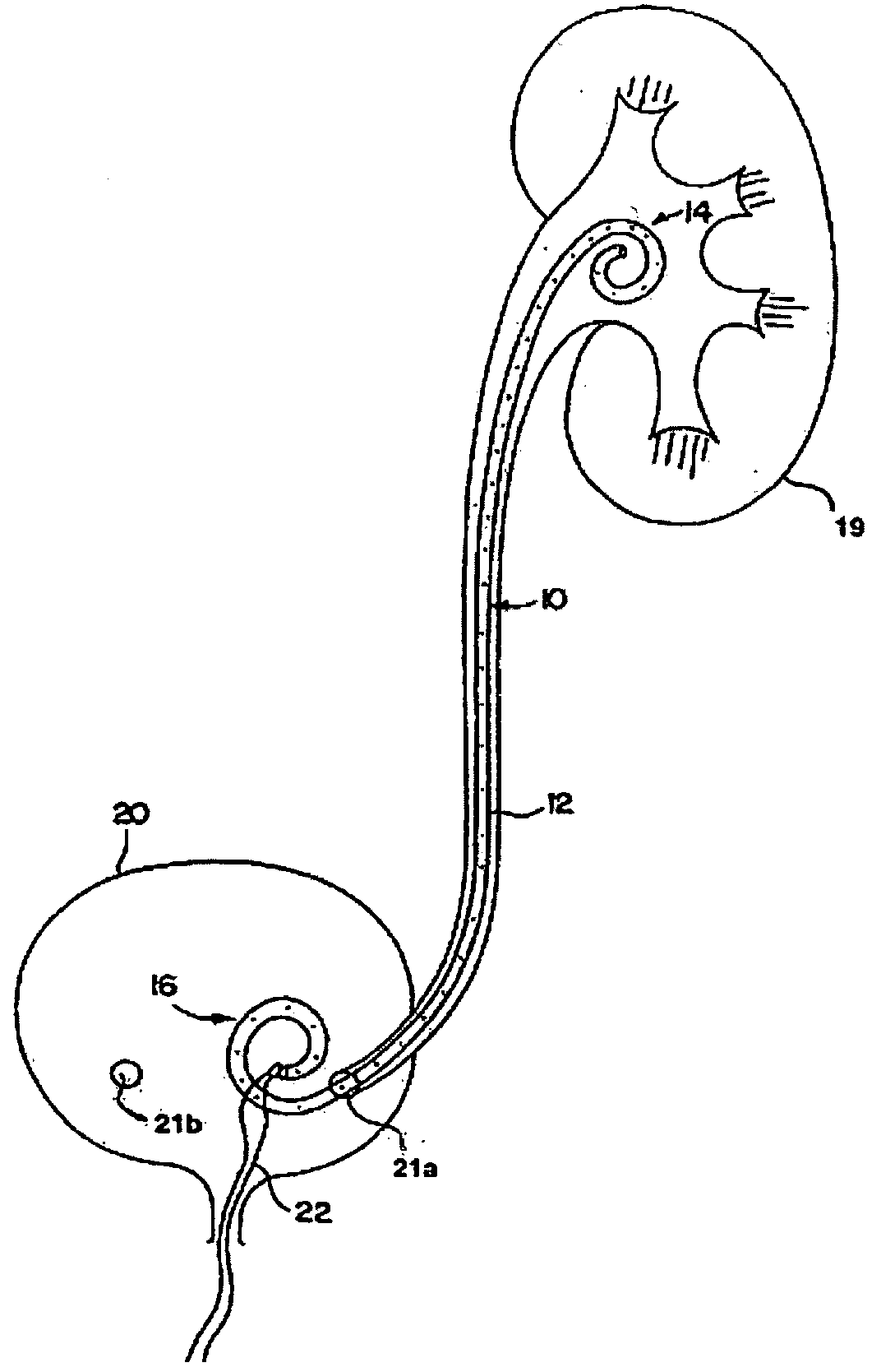 Ureteral stents for release of urologically beneficial agents