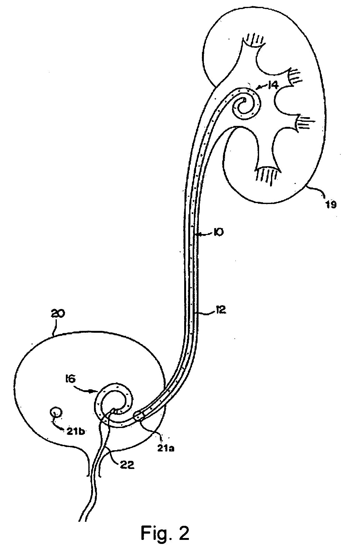 Ureteral stents for release of urologically beneficial agents