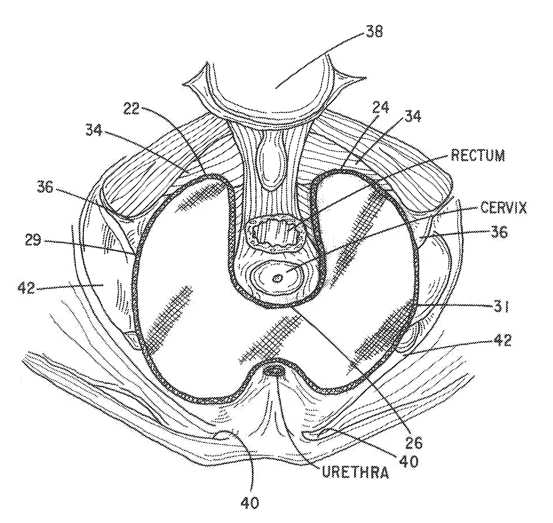 Apparatus and Method for Pelvic Floor Repair in the Human Female