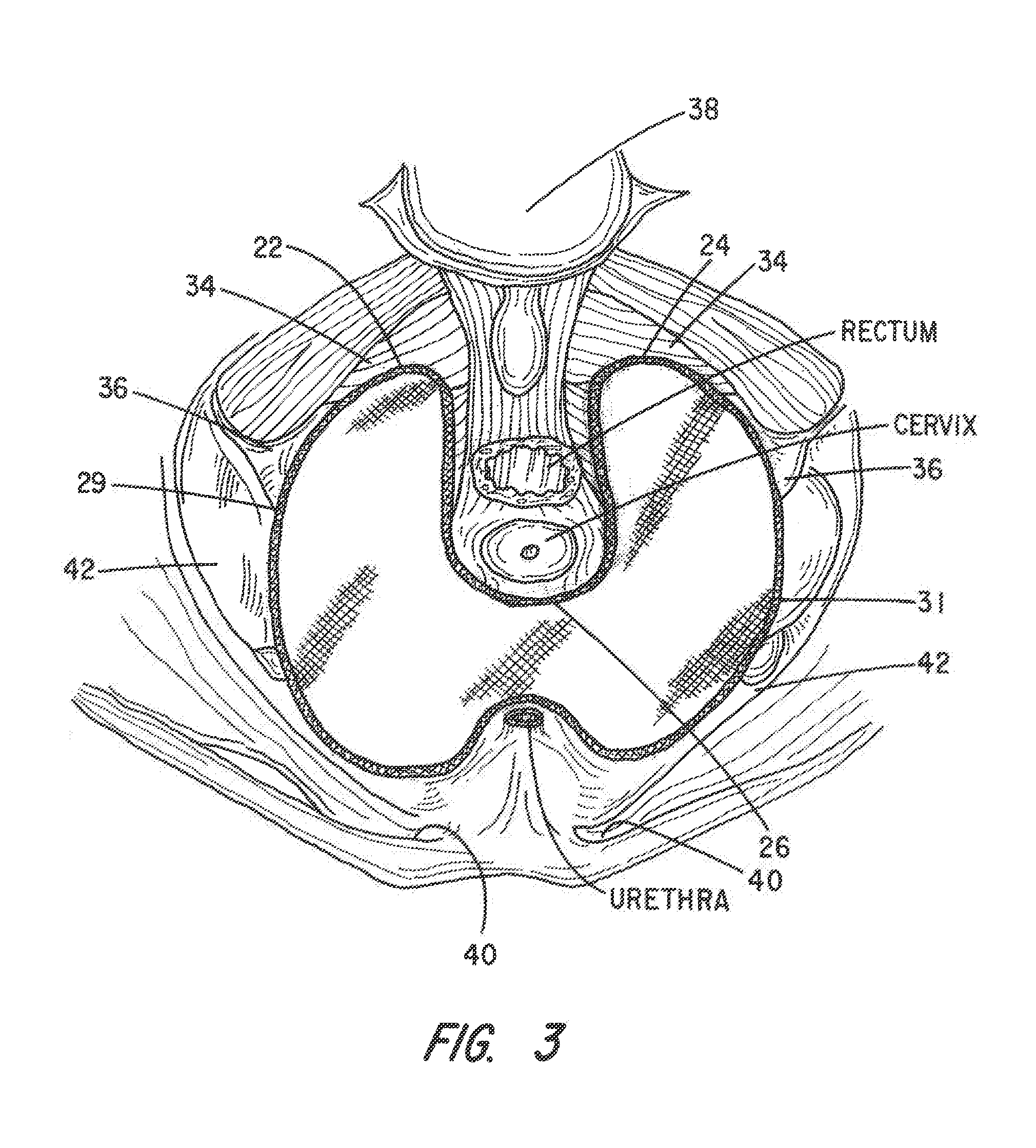 Apparatus and Method for Pelvic Floor Repair in the Human Female