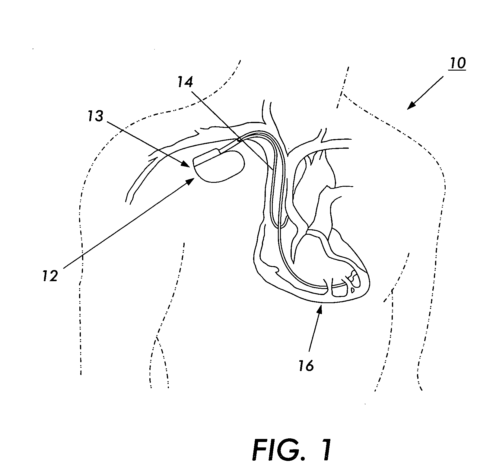 Device and method for preventing magnetic-resonance imaging induced damage